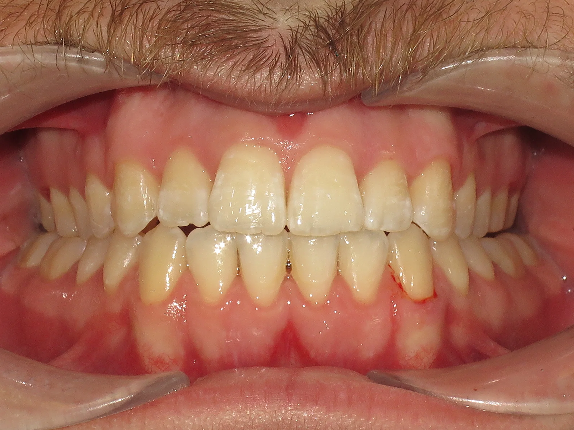 Close-up of aligned upper teeth after Invisalign treatment at Mississauga Smiles.