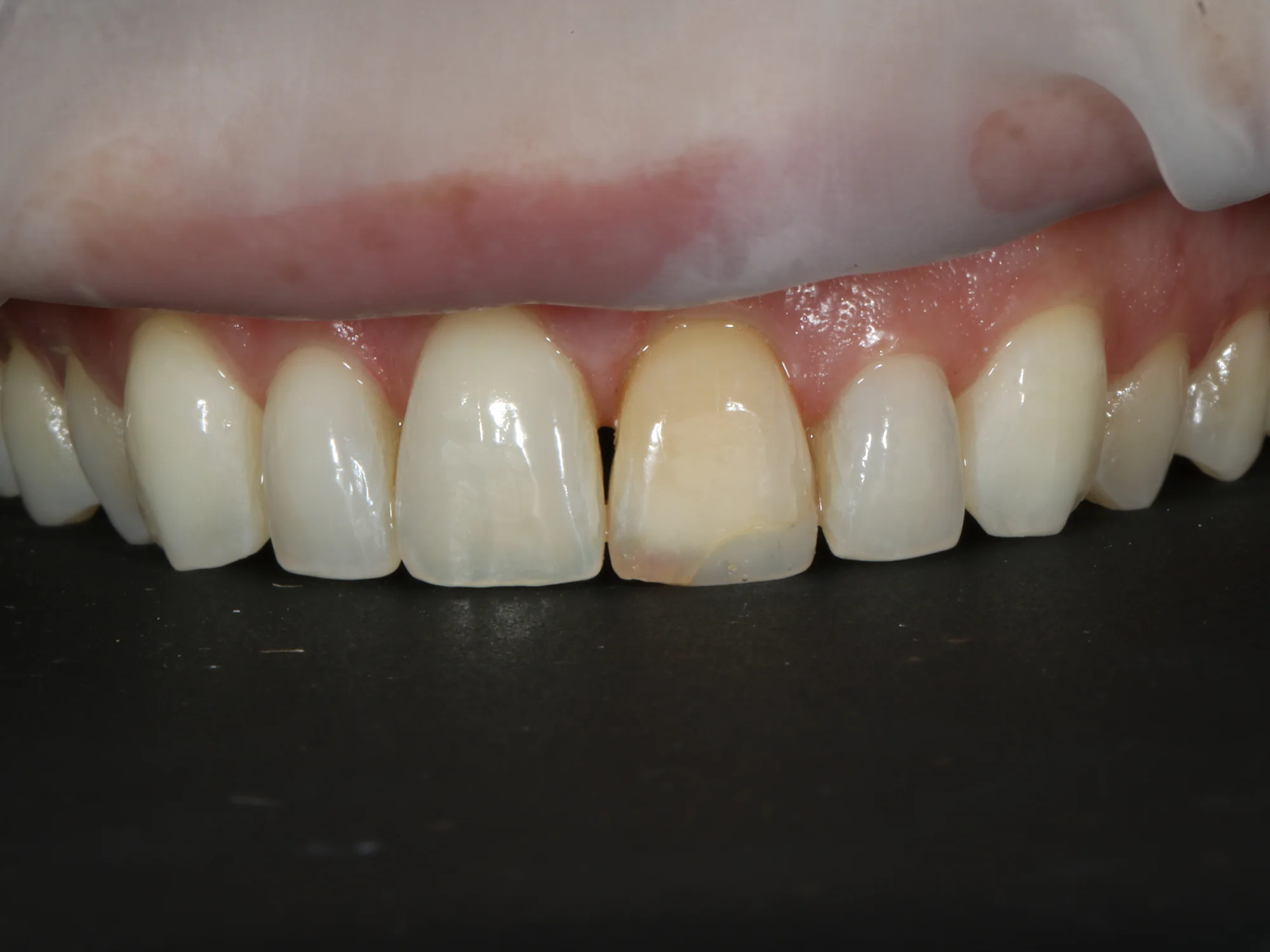 Front tooth with discoloration and visible damage