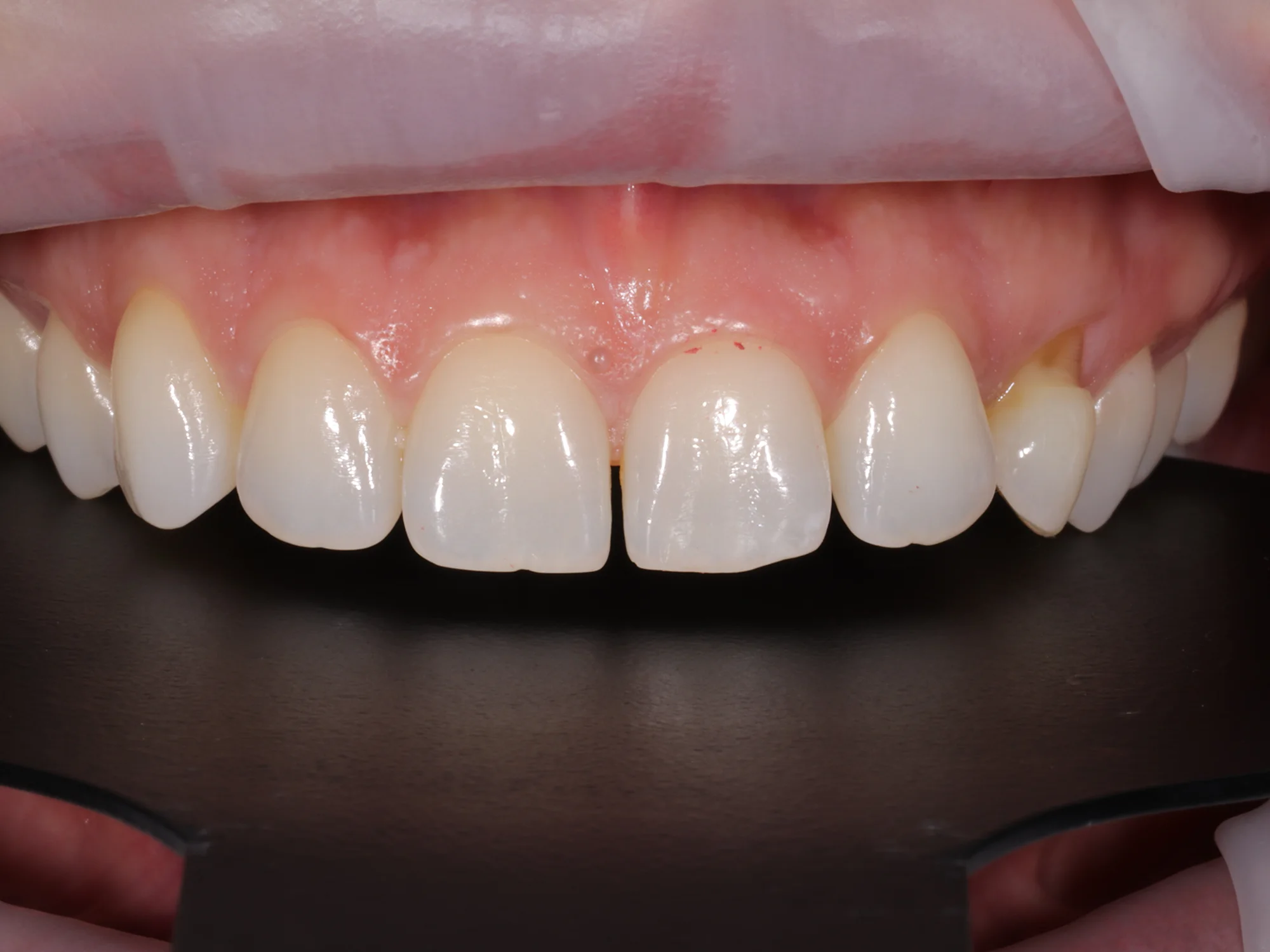 Upper teeth showing uneven lengths and small gaps, assessed using alignment tool