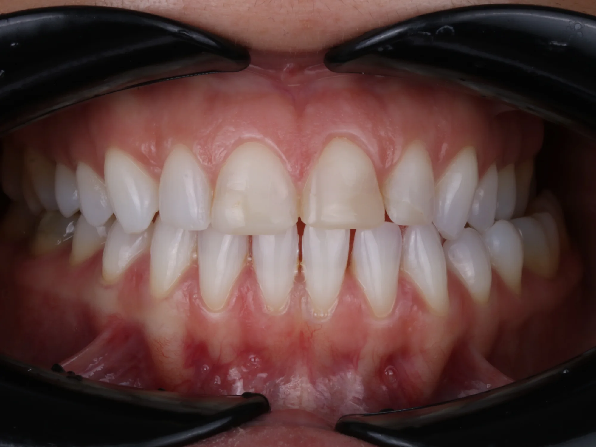 Discolored and uneven upper front teeth.