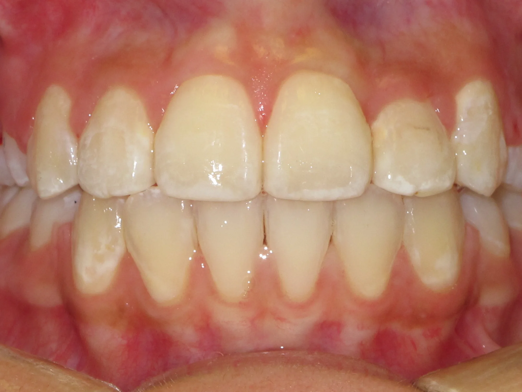 Perfectly aligned teeth after successful braces treatment