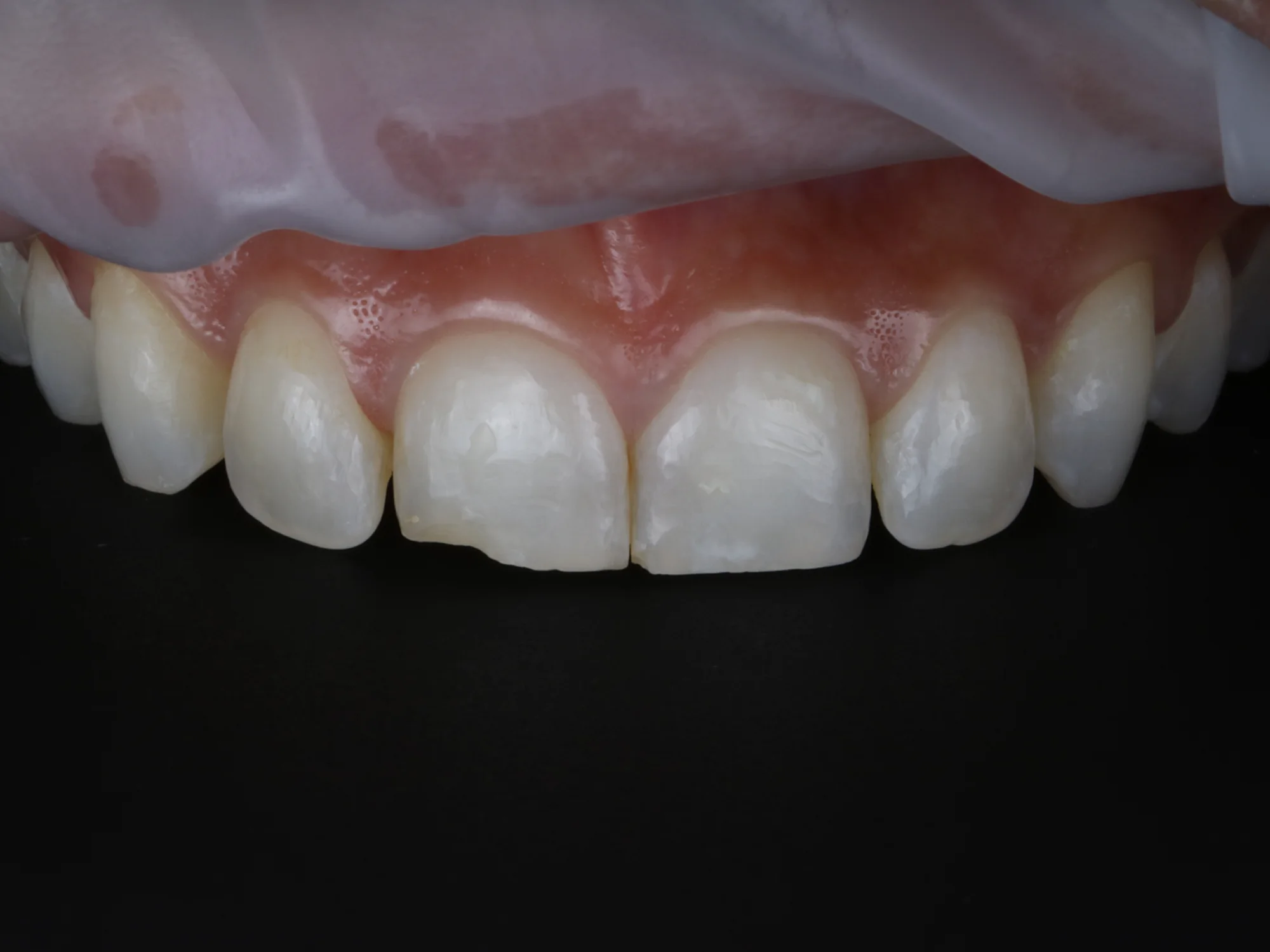 Close-up before smile makeover treatment showing discoloration and enamel wear.