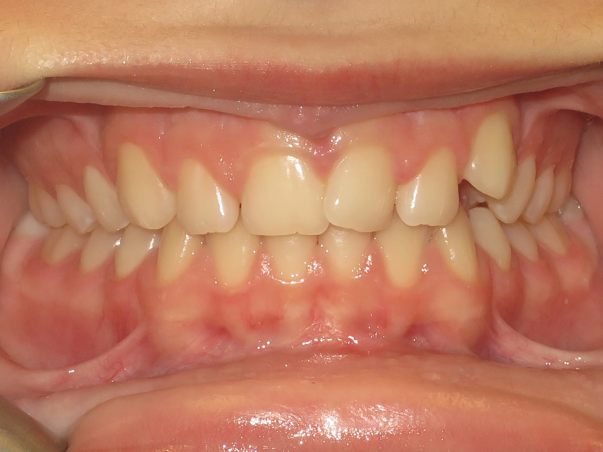 Lower teeth pushed inward, upper teeth misaligned, with front teeth overlapping.