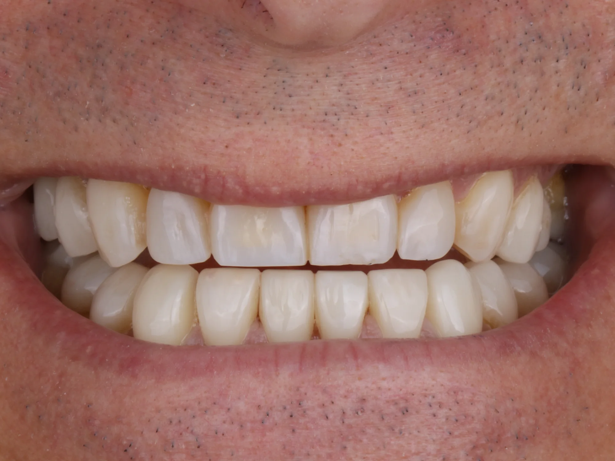 Close-up of a bright, symmetrical smile after smile makeover treatment
