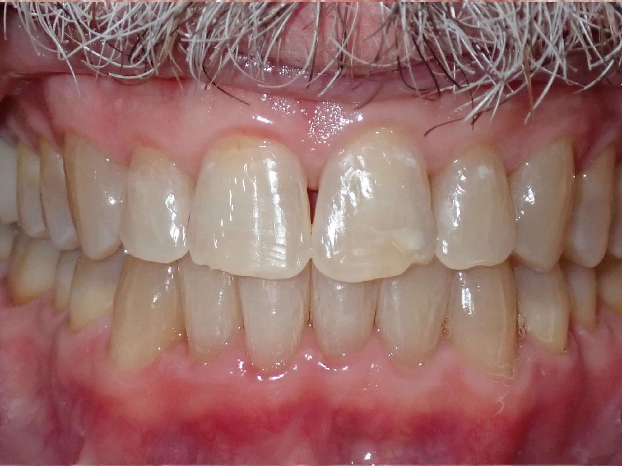 Straightened upper and lower teeth after Invisalign treatment
