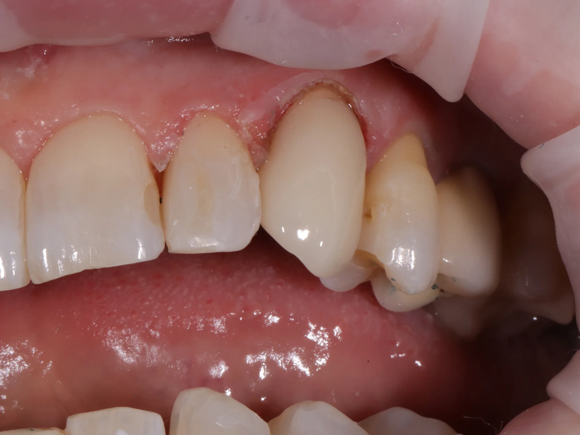 Close-up of a front tooth after same-day crown placement, showing flawless restoration.