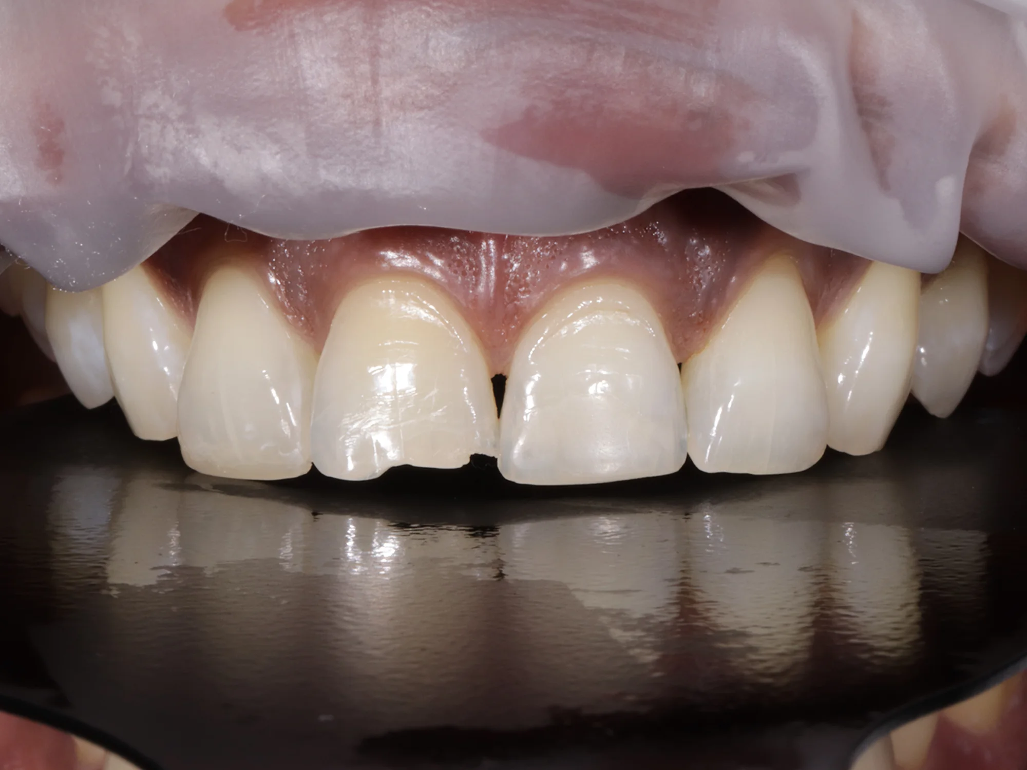 Chipped upper front teeth before cosmetic dental treatment