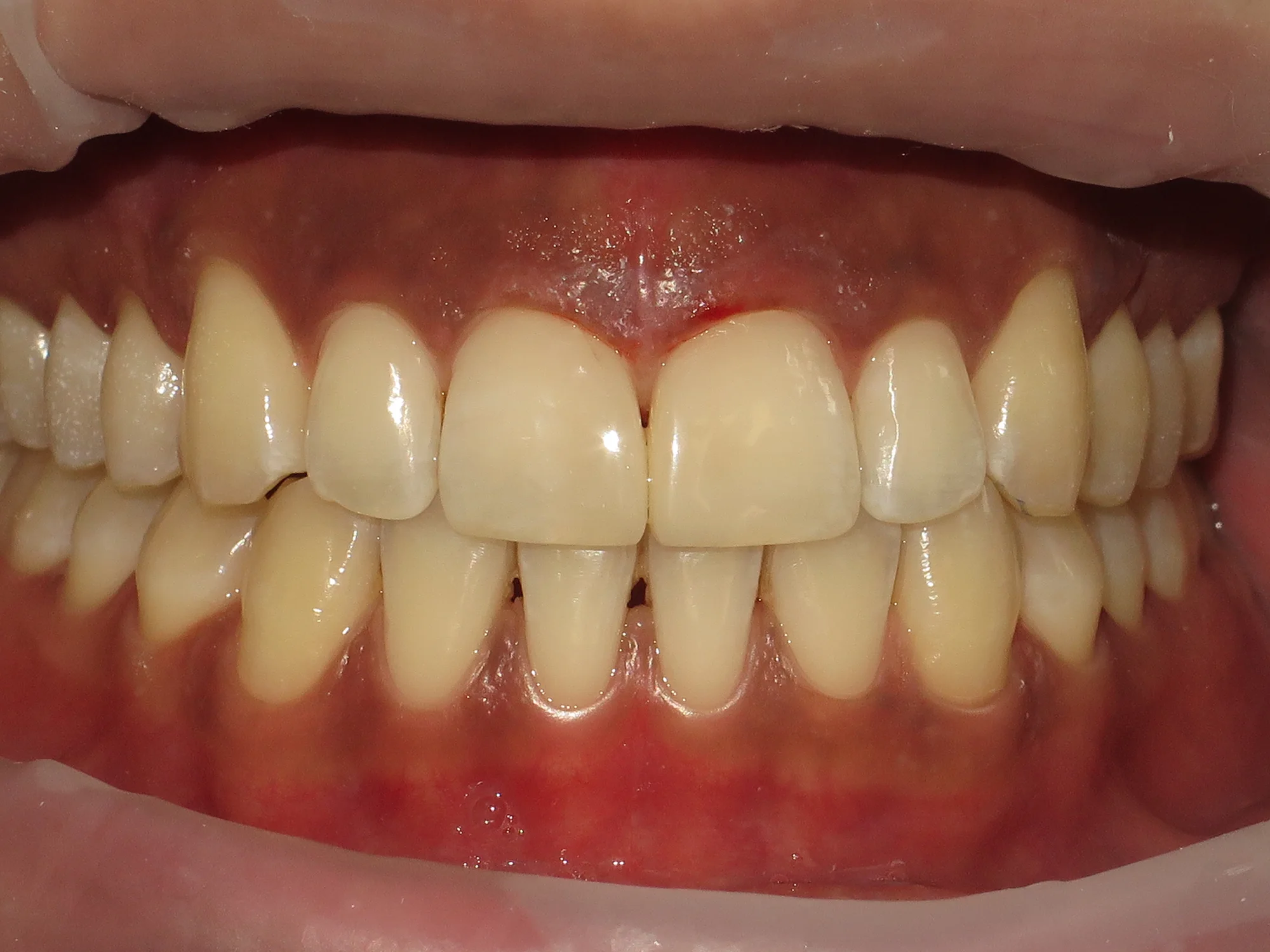 Close-up of aligned upper teeth after smile makeover, with the front gap closed