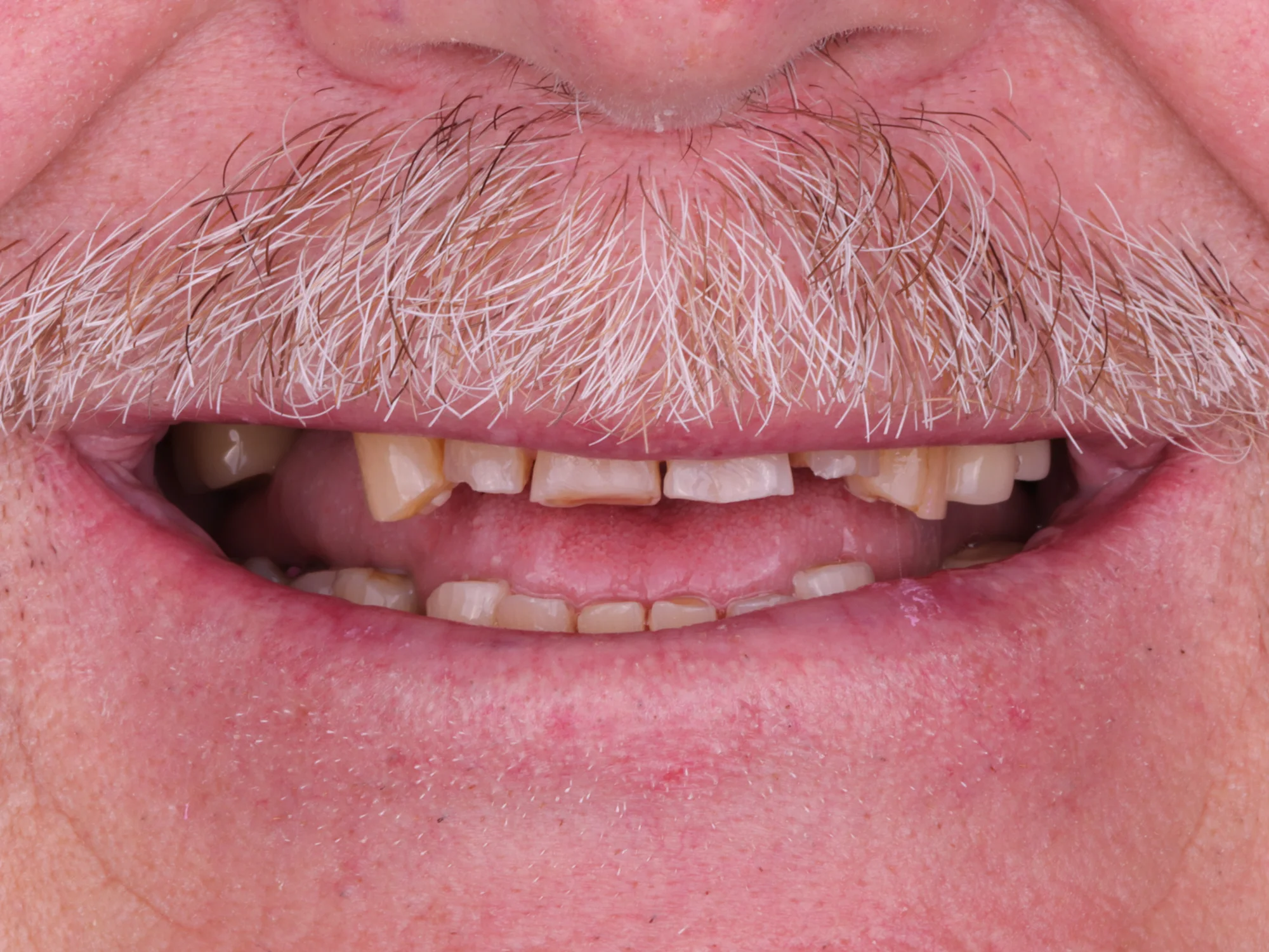 Close-up of a smile showing damaged, discolored, and missing teeth before dental restoration.