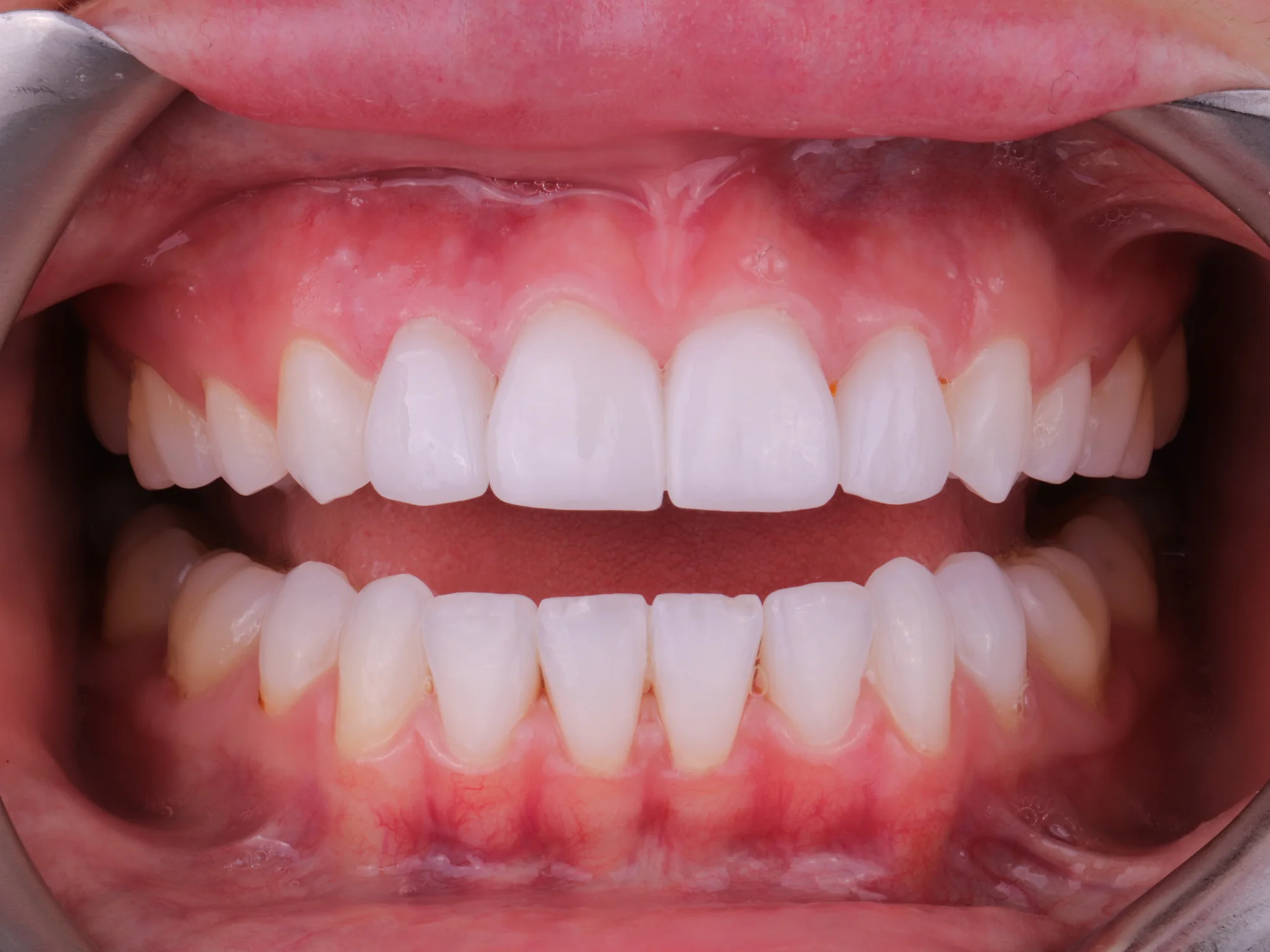 Evenly aligned upper teeth after porcelain veneers, with no visible gap.