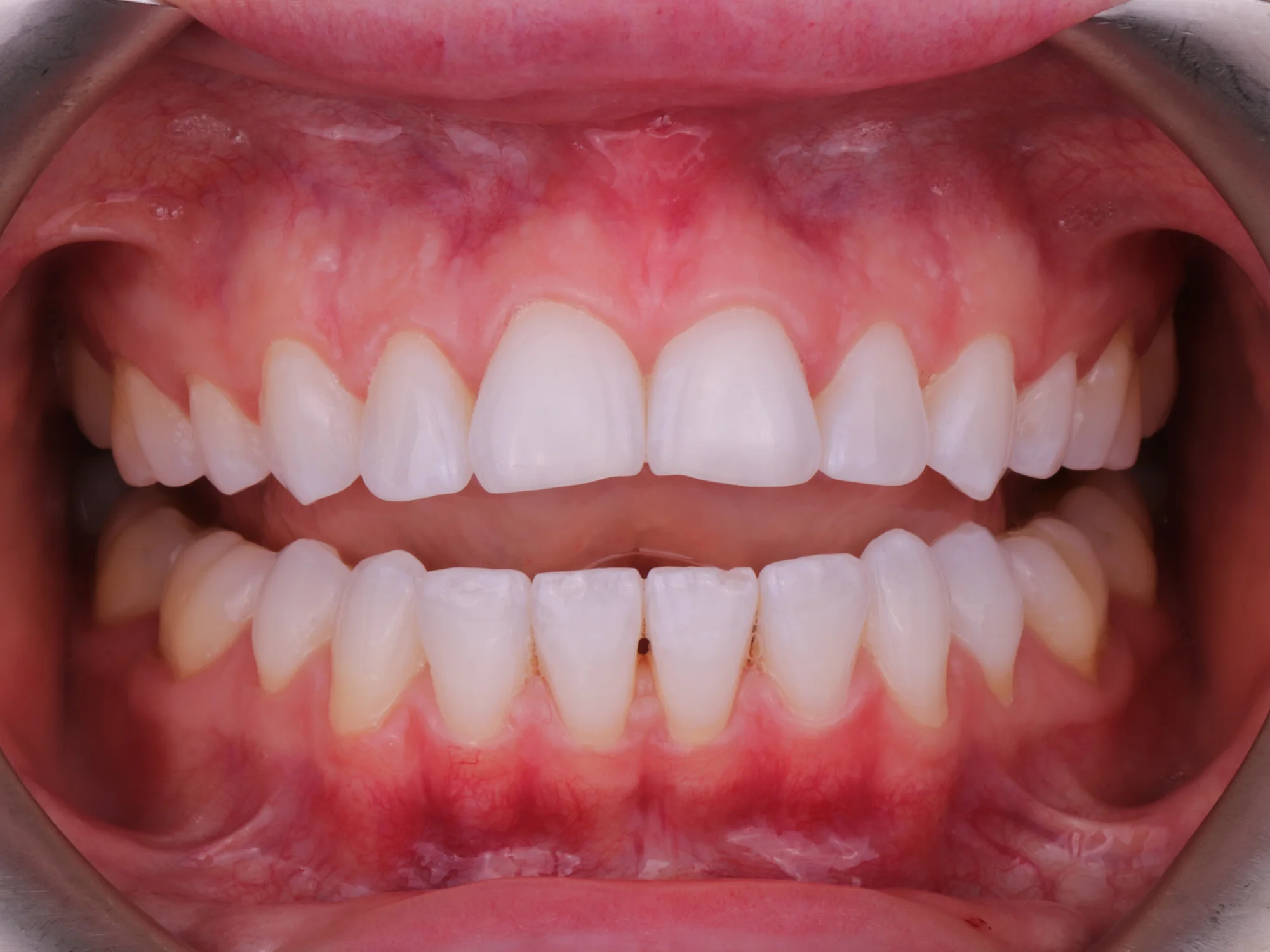 Short upper teeth revealing tongue gap before porcelain veneer treatment.
