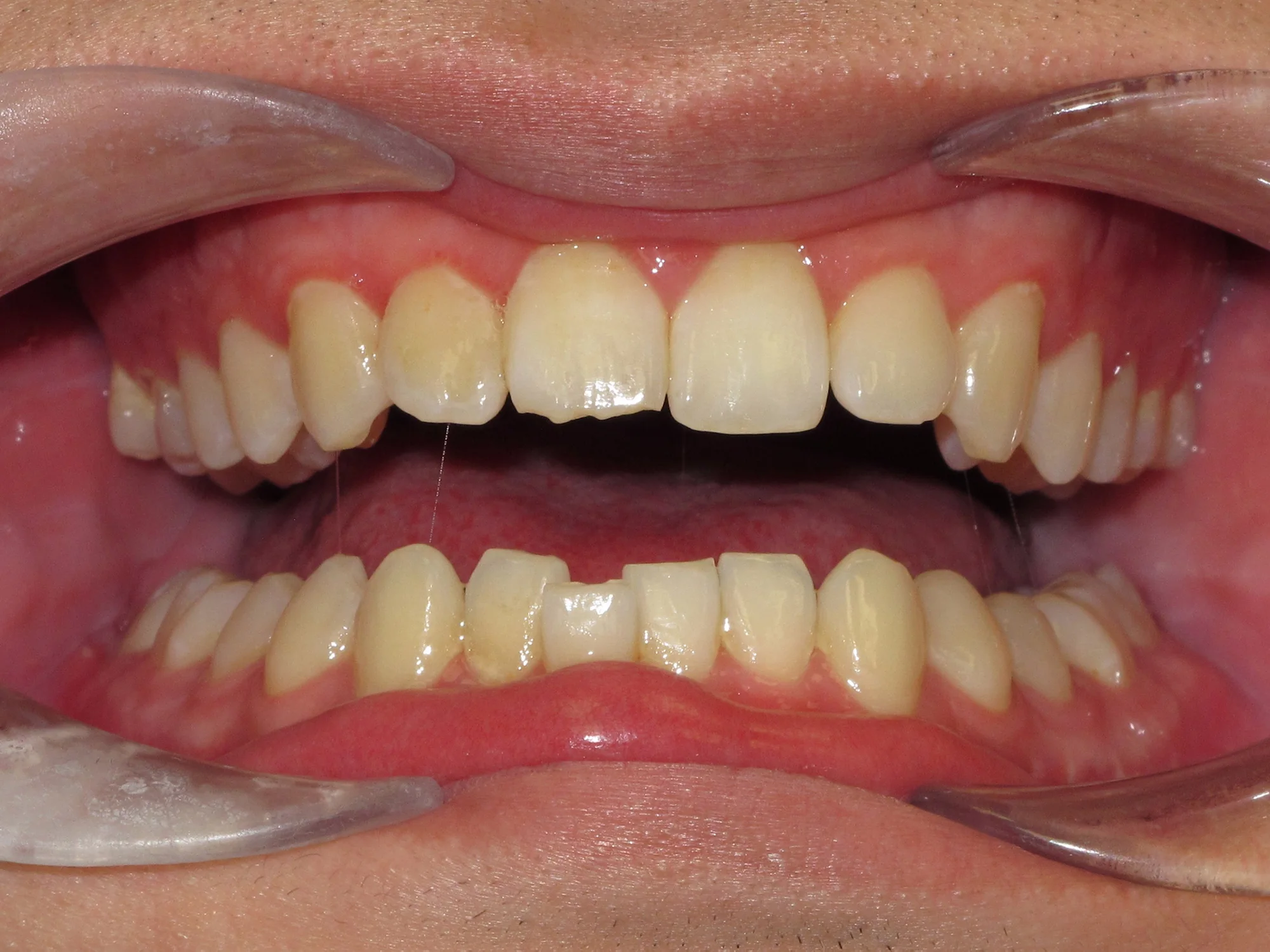 Lower front teeth showing visible misalignment and crowding before treatment