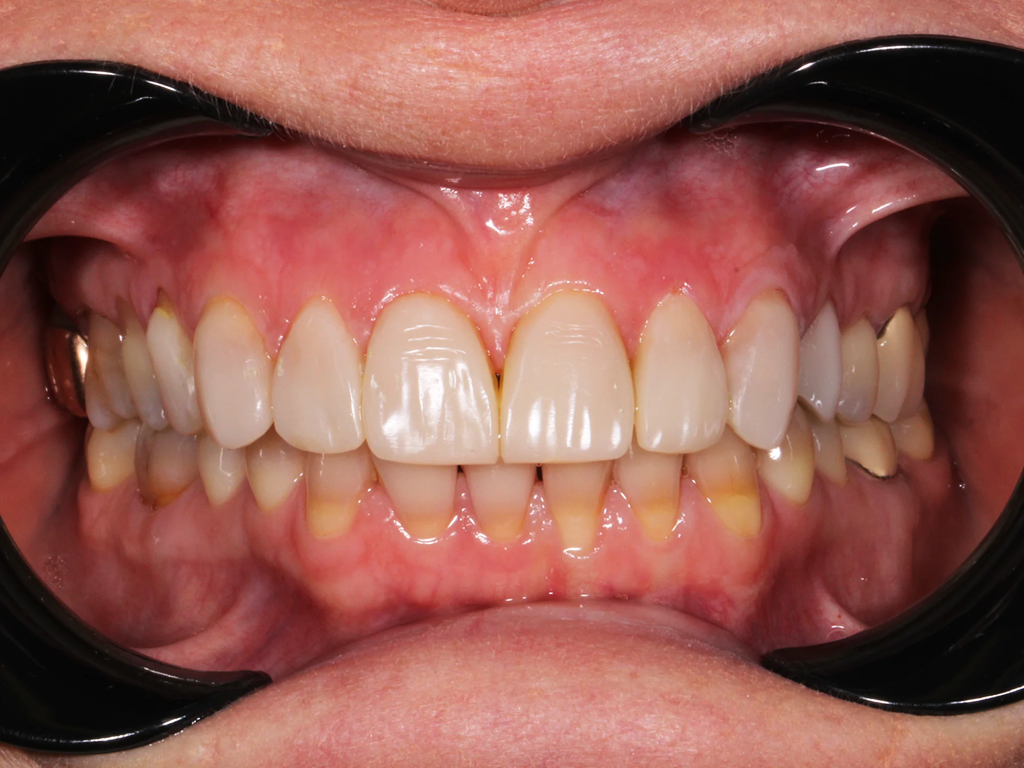 Close-up of teeth after smile makeover showing whiter and even teeth