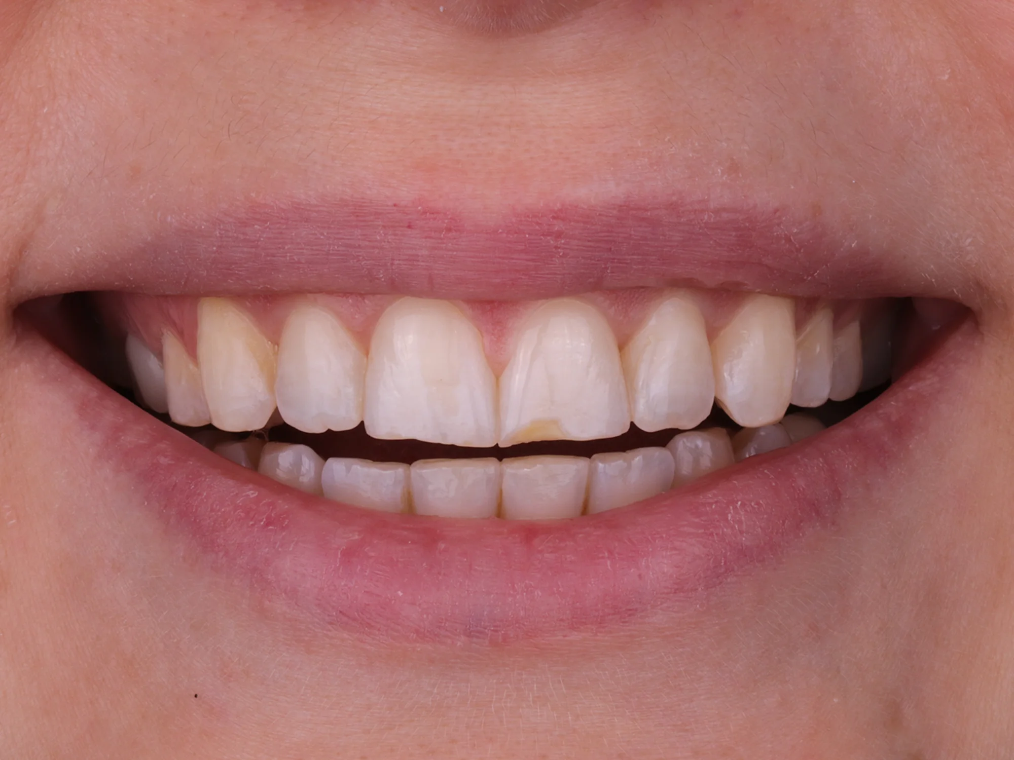 Close-up of chipped and discolored front teeth before smile makeover