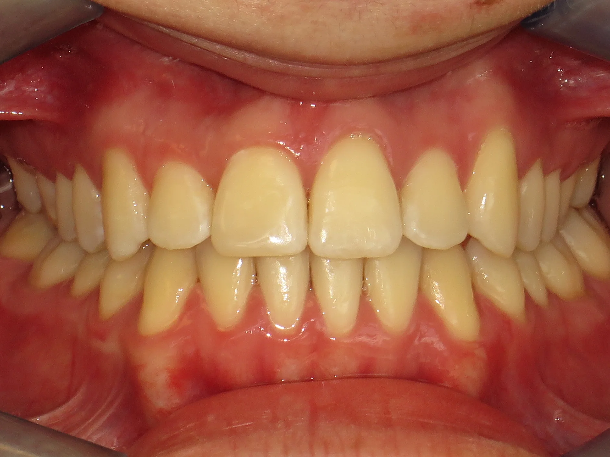 Straight and aligned teeth after orthodontic braces treatment.