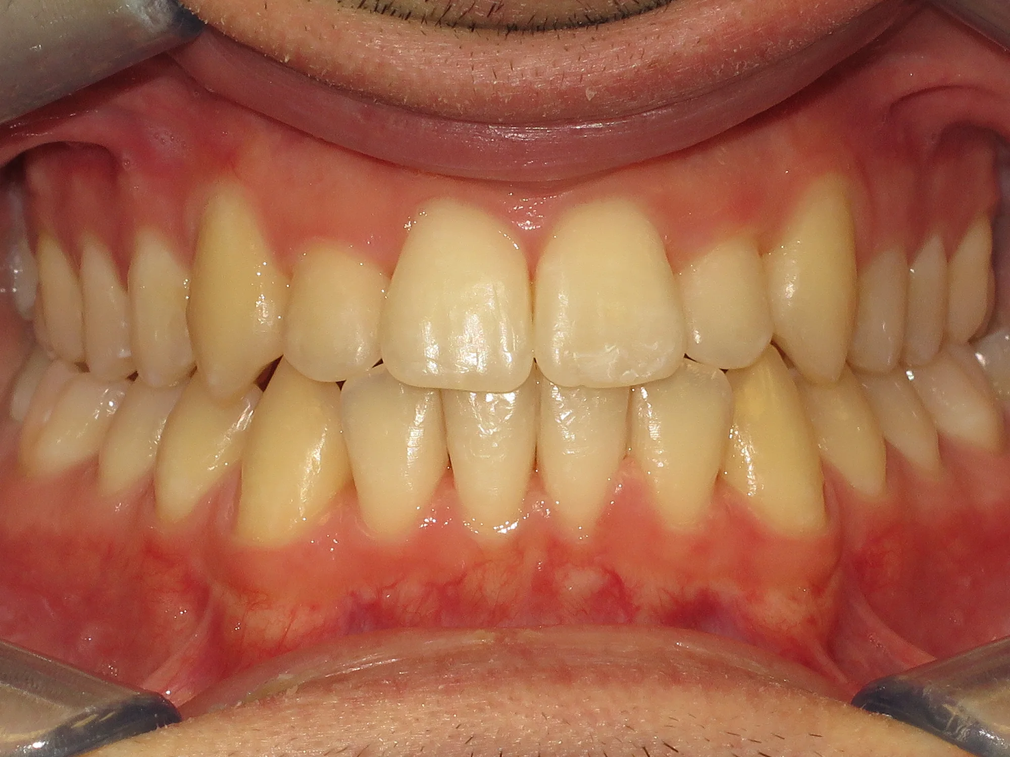 Close-up of aligned teeth after Invisalign at Mississauga Smiles.