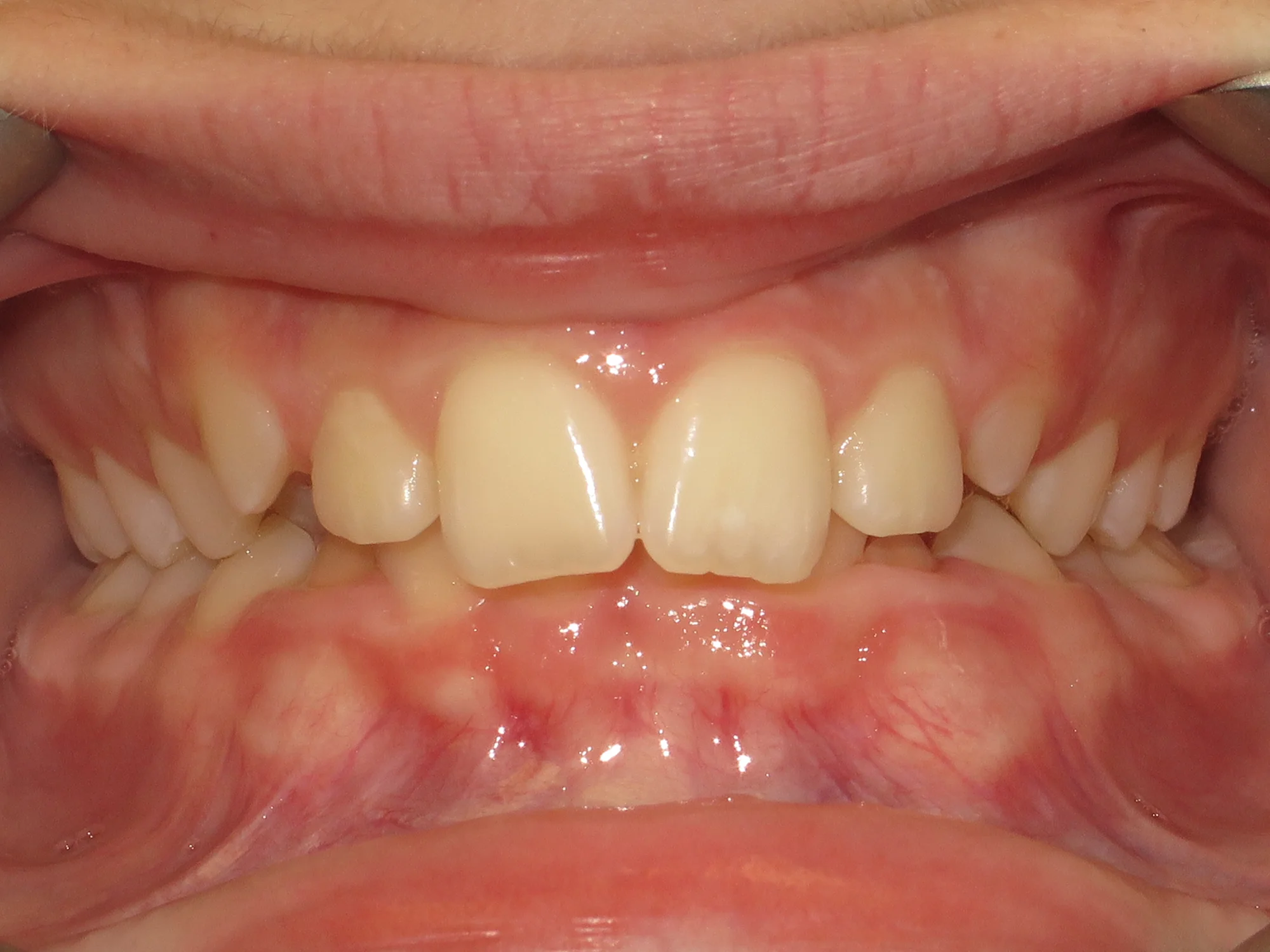 Close-up of upper and lower teeth showing misalignment and spacing before braces.