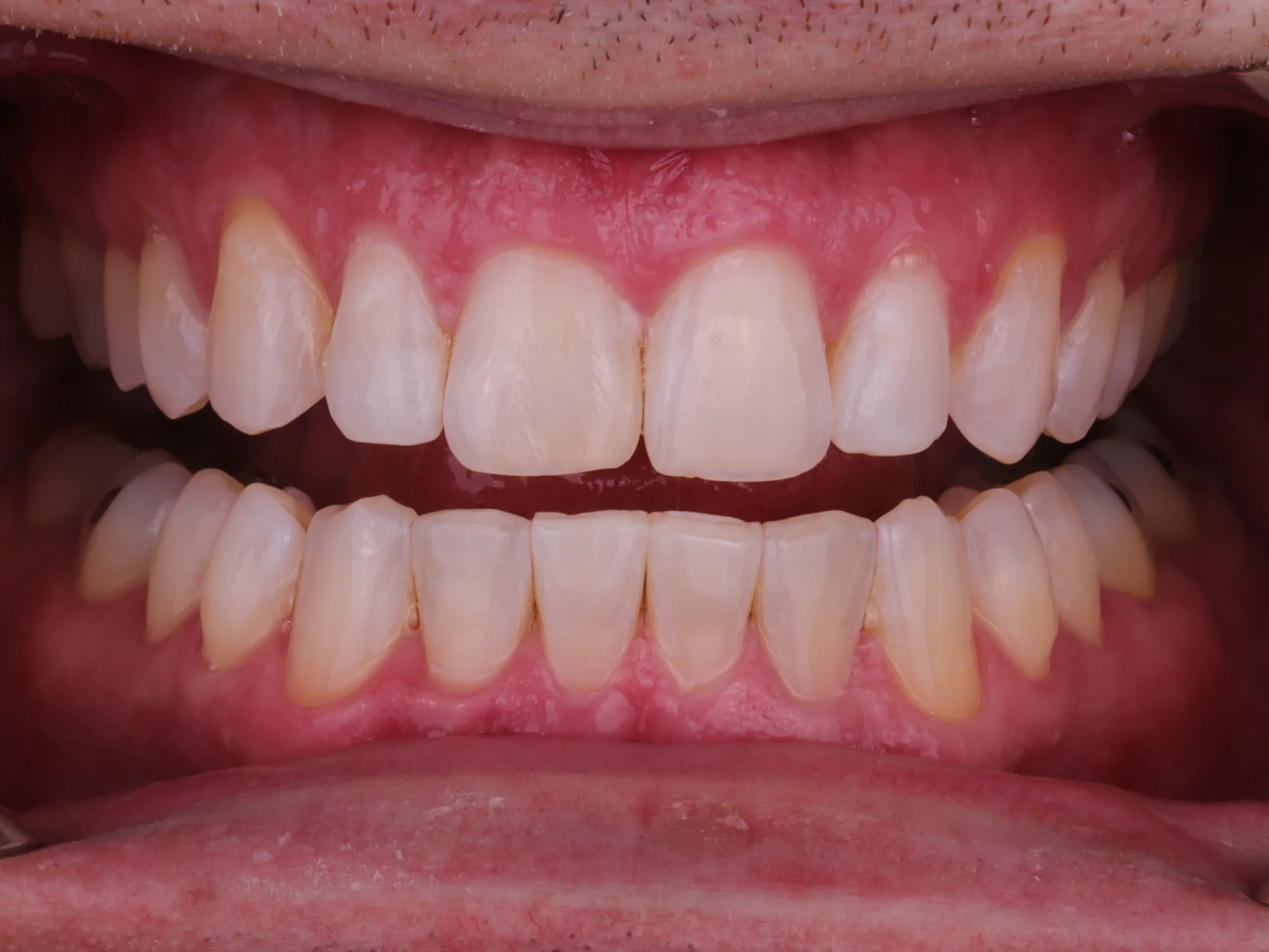 A beautiful smile after teeth alignment and veneers, showcasing evenly spaced, bright teeth.