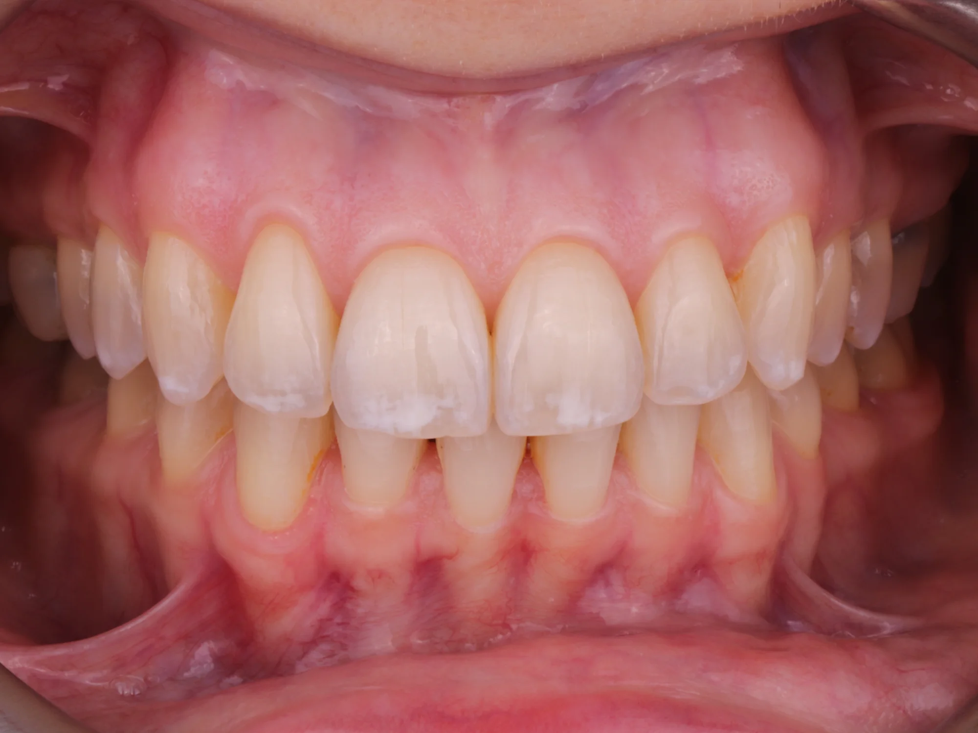A set of natural teeth with slight misalignment and dull before getting veneers.