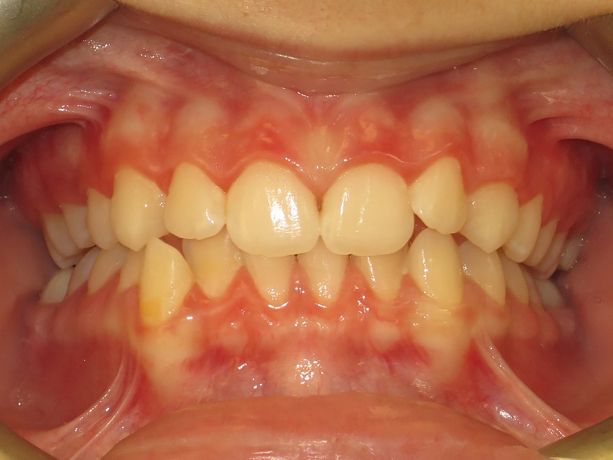 Lower teeth crowded and overlapping, showing signs of dental misalignment