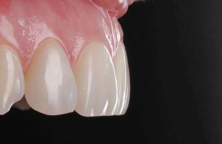 Close-up of veneers made using CEREC dental technology