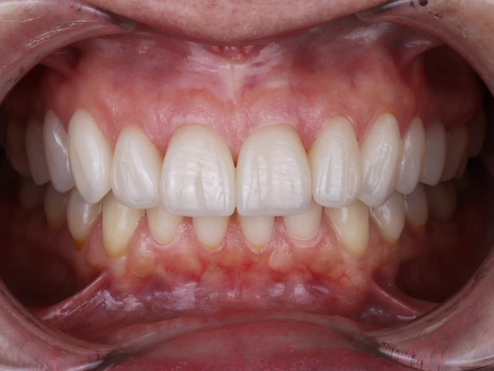 Bright upper teeth with veneers at Mississauga Smiles.