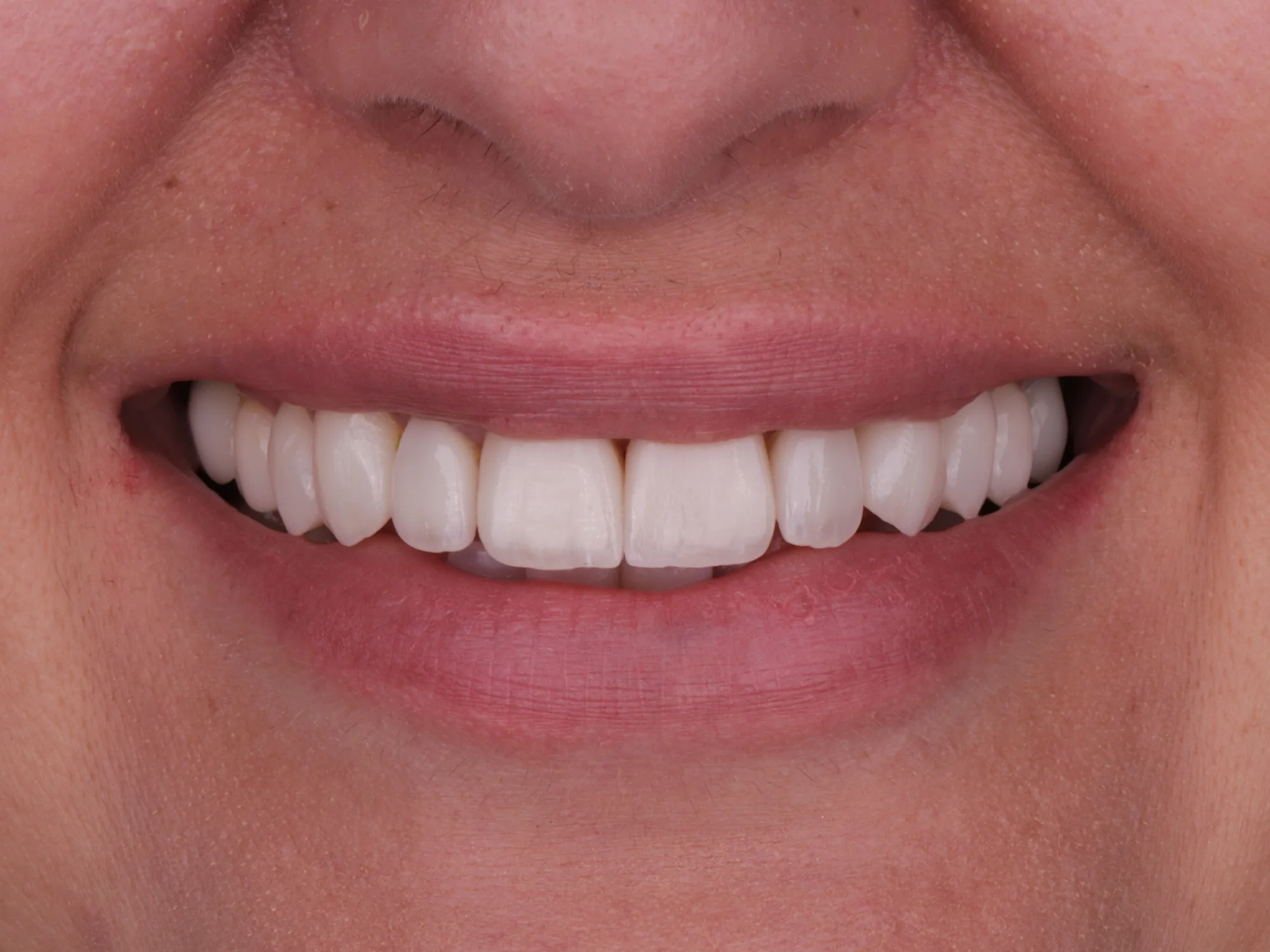 Upper teeth after porcelain veneers at Mississauga Smiles Dentistry