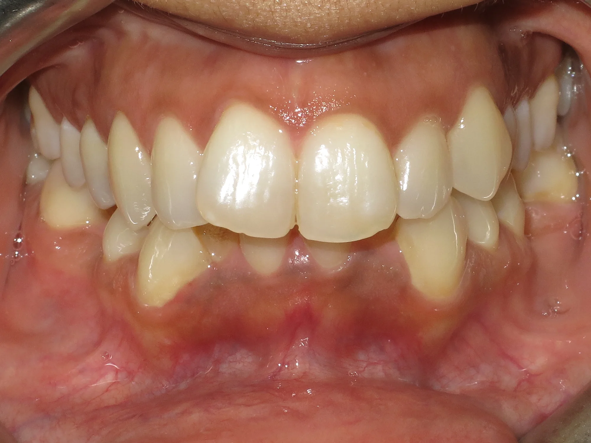 Close-up of upper teeth with slightly protruding central incisors and lower teeth tilted inward