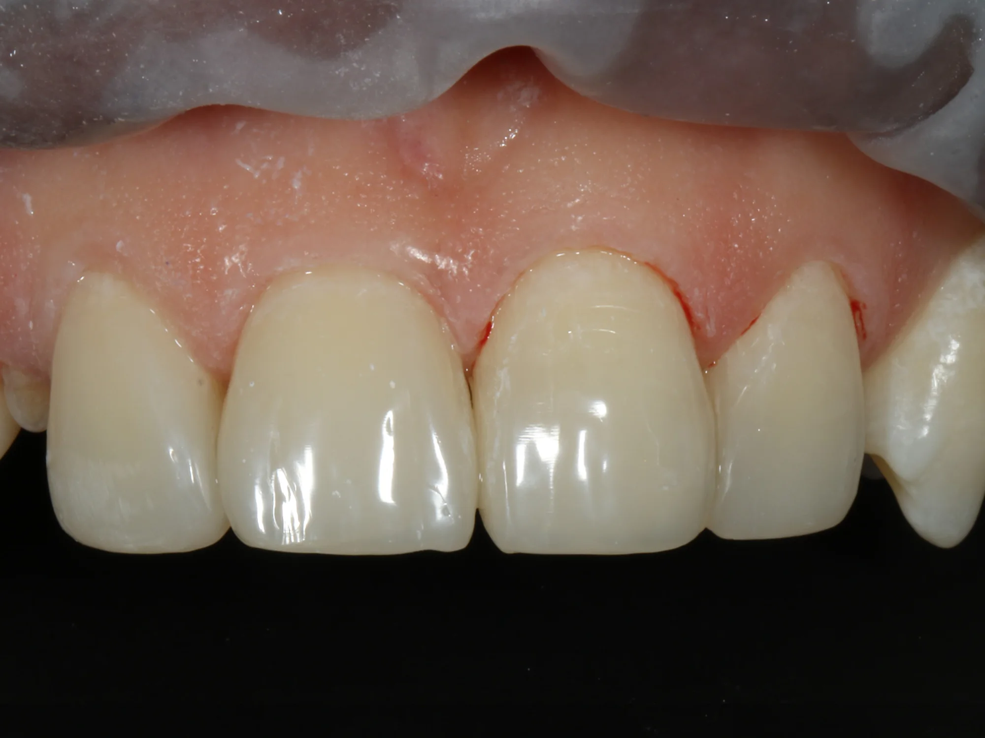 Close-up of upper front teeth after smile makeover showing aligned and polished teeth