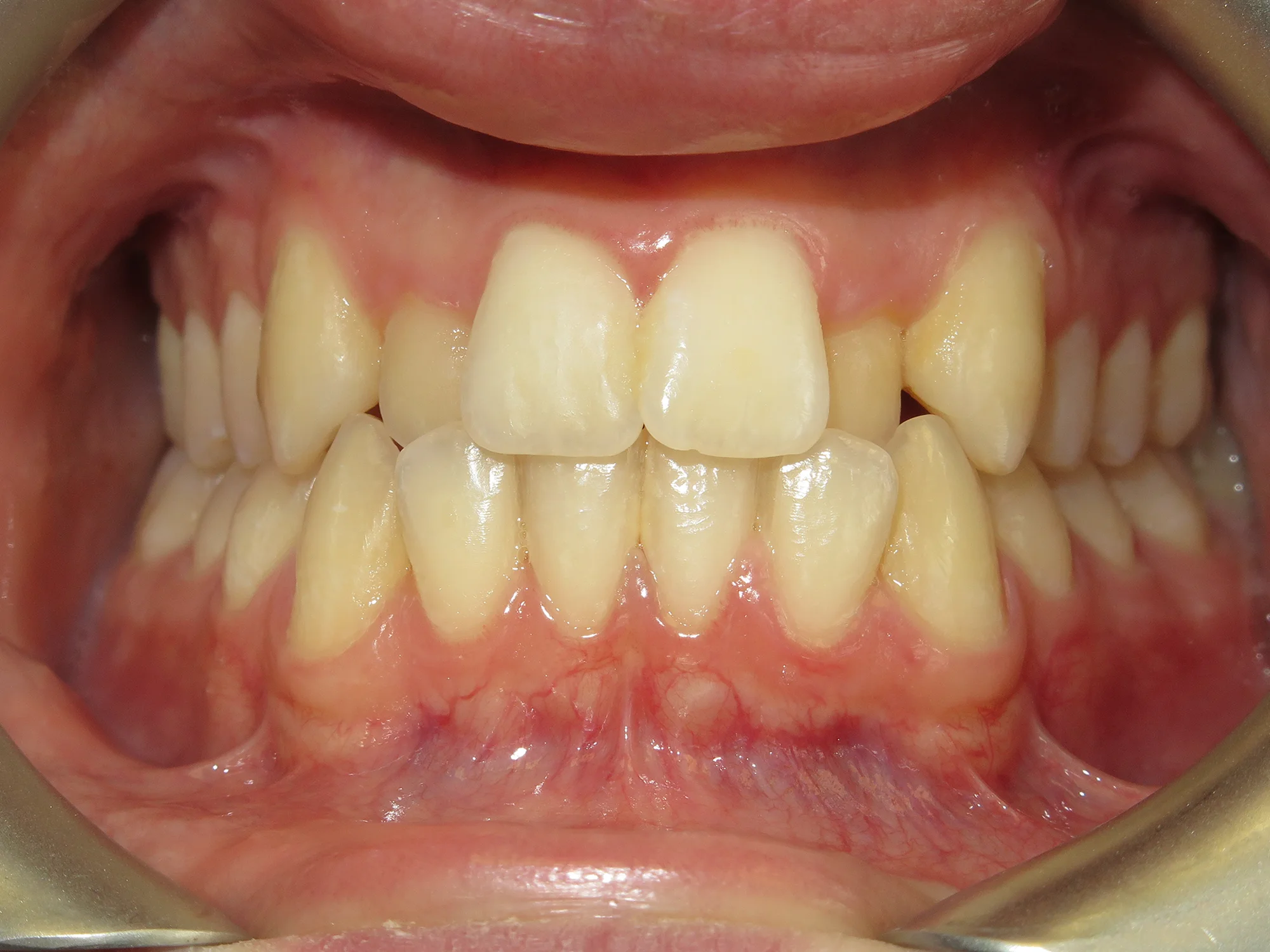 Close-up of upper and lower teeth misalignment before Invisalign
