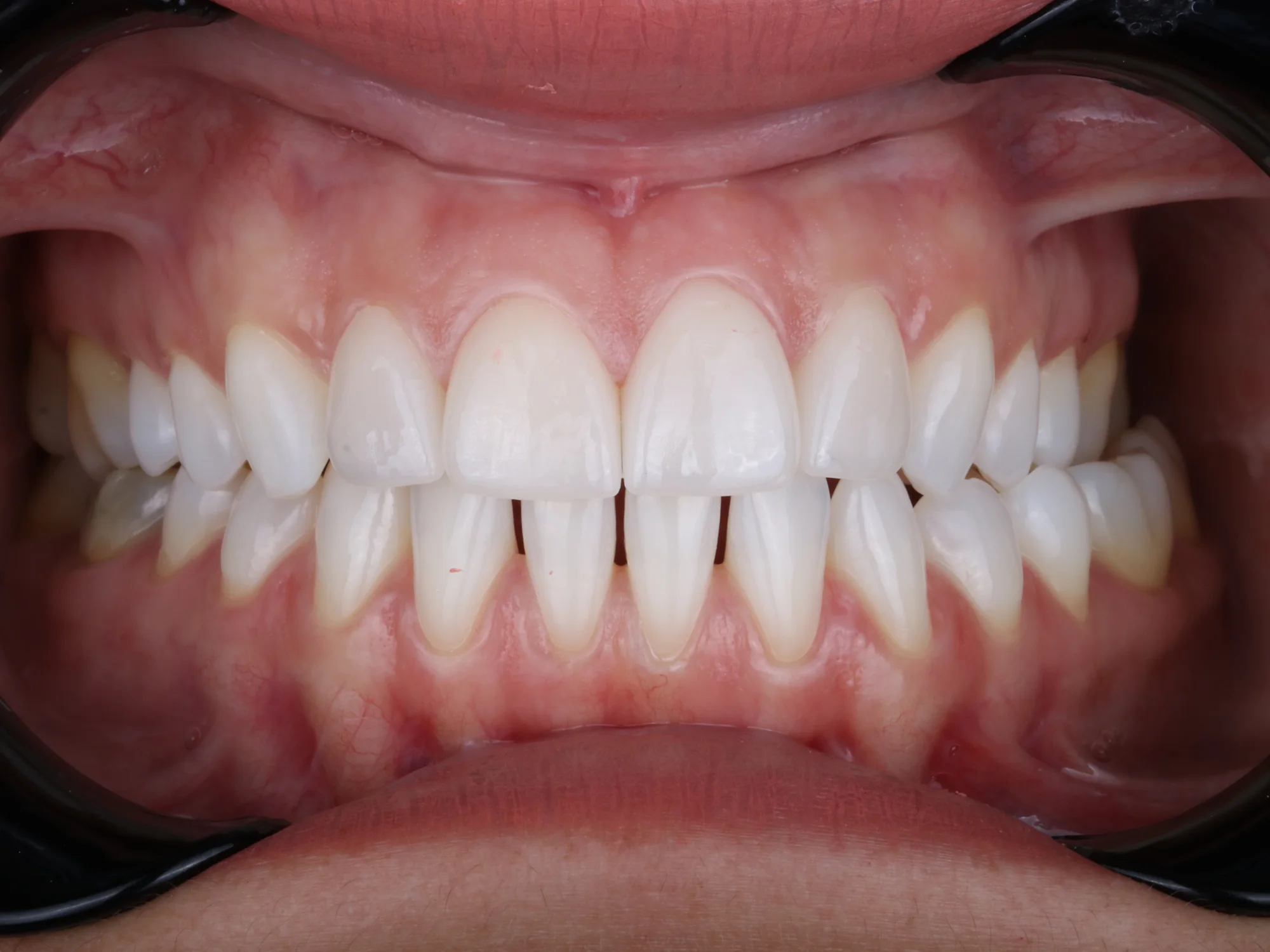 Even-toned and natural-looking upper front teeth after treatment.
