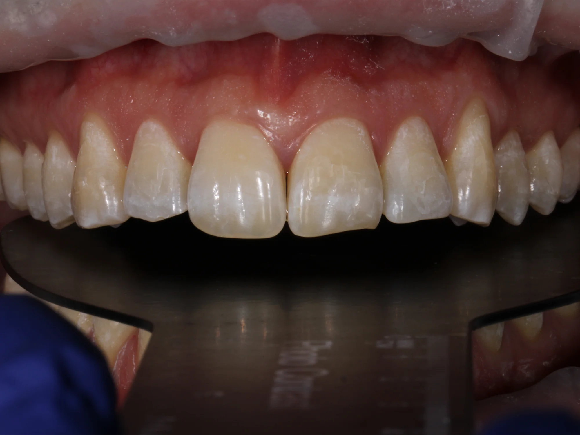 Upper front teeth with visible gaps, uneven lengths, and discoloration