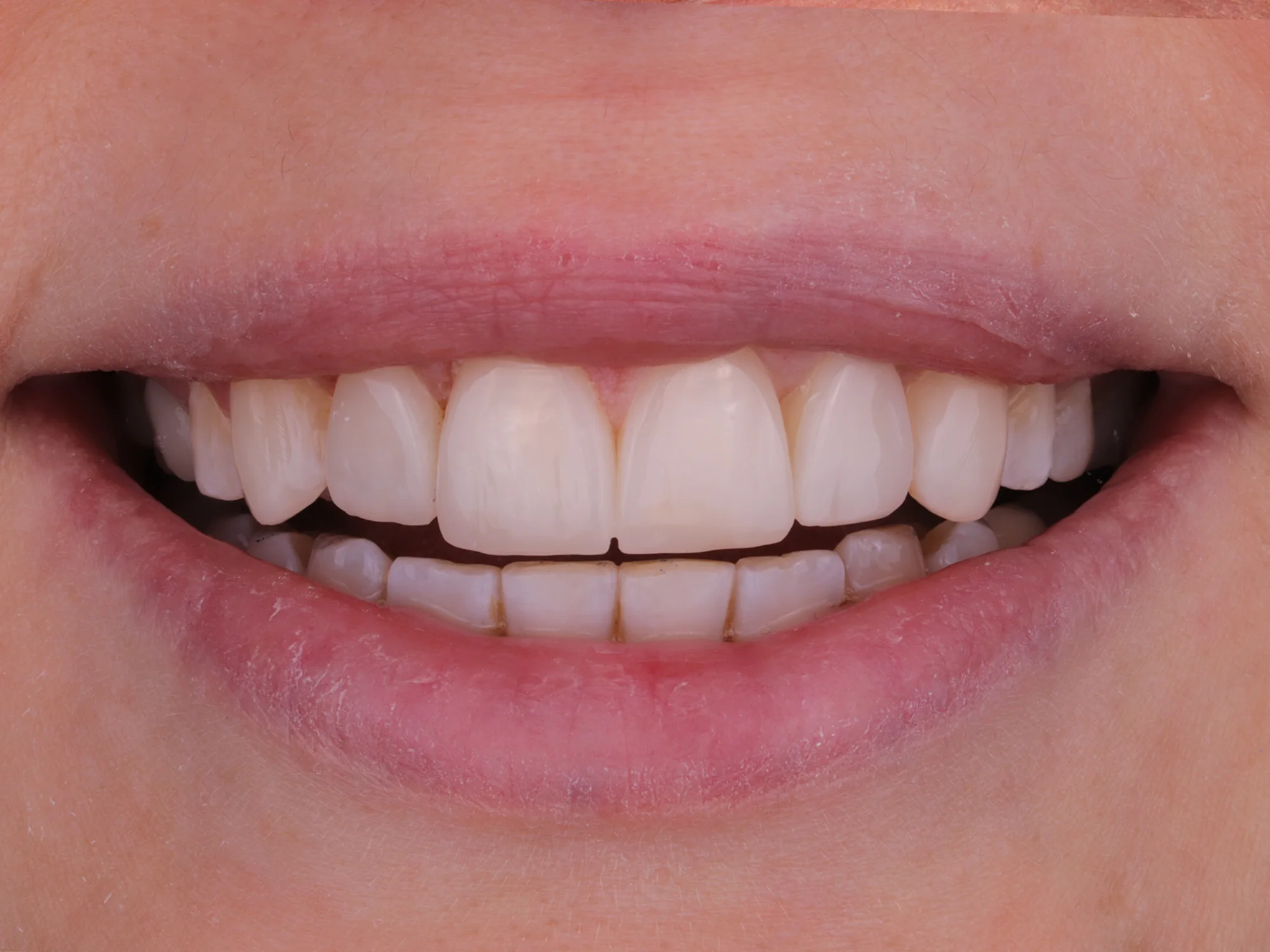 Close-up of restored, even, and bright teeth after smile makeover
