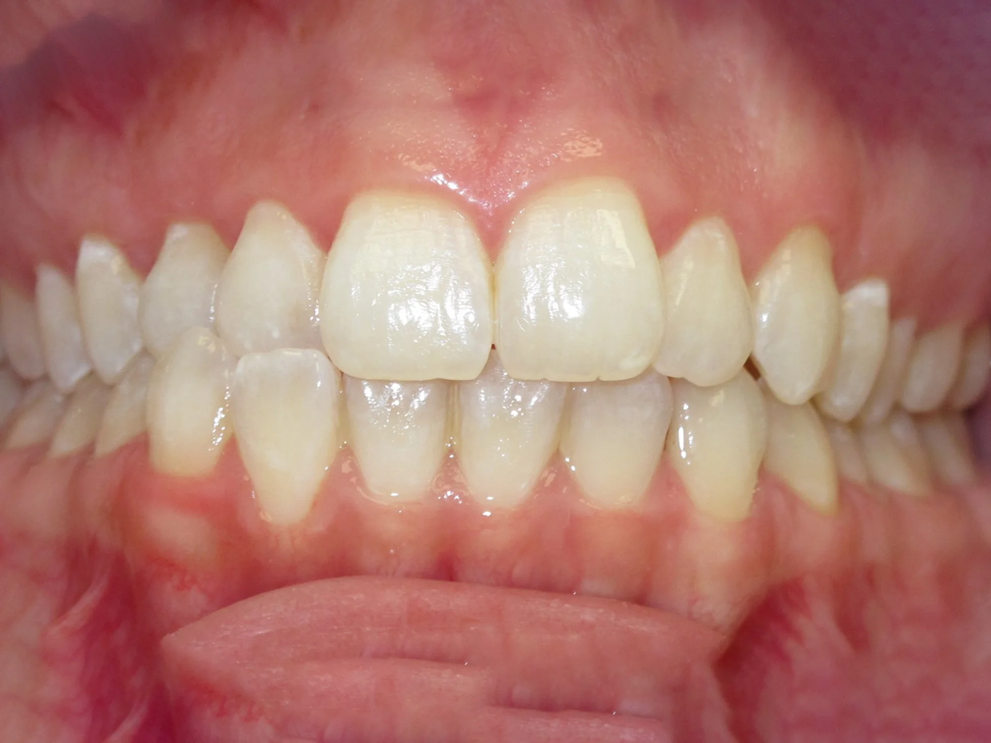 Upper front teeth not aligned with surrounding teeth, showing visible crowding