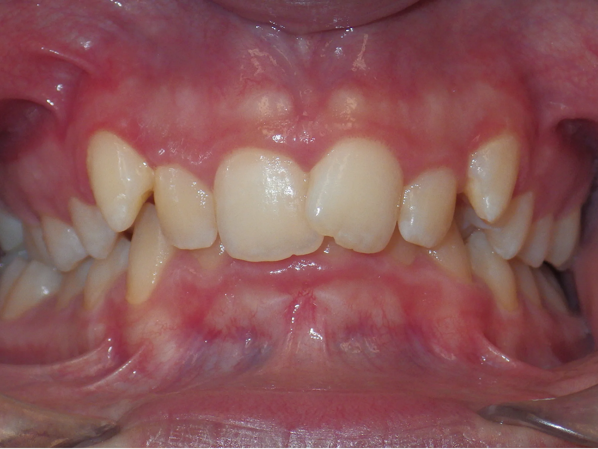 Close-up of crowded and misaligned teeth before orthodontic treatment