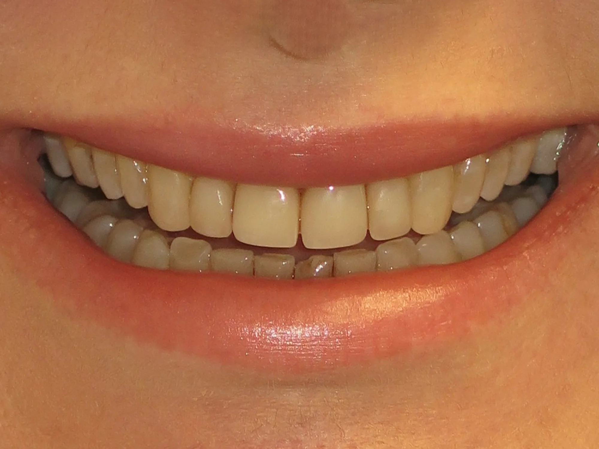 Close-up of misaligned and stained teeth