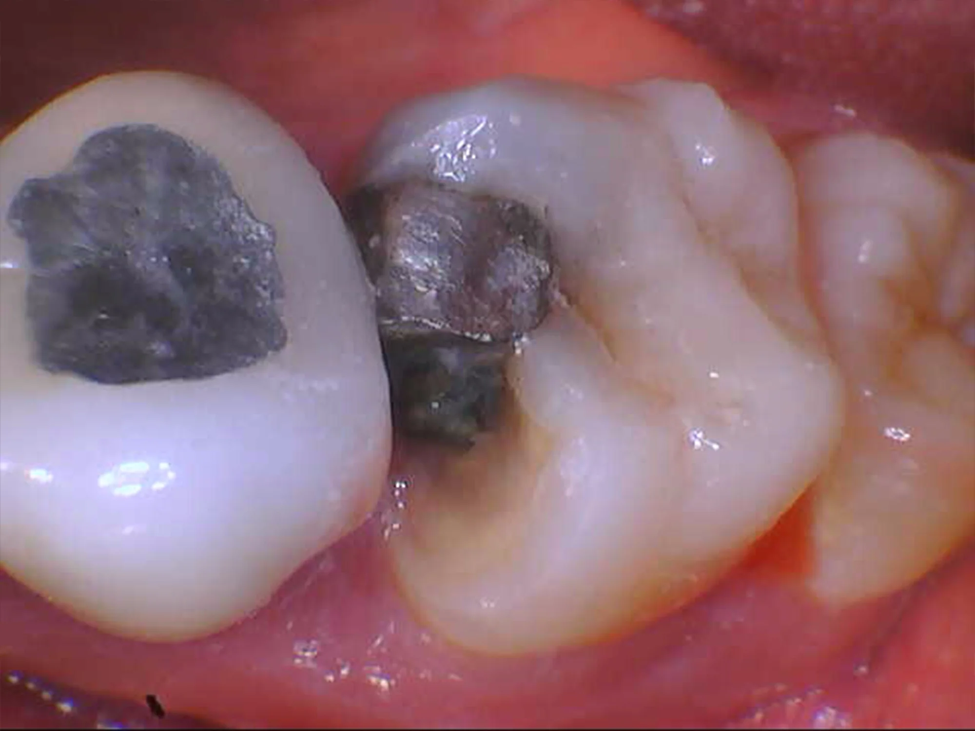 Close-up of molars with old metal fillings, including a damaged tooth with visible wear and decay.