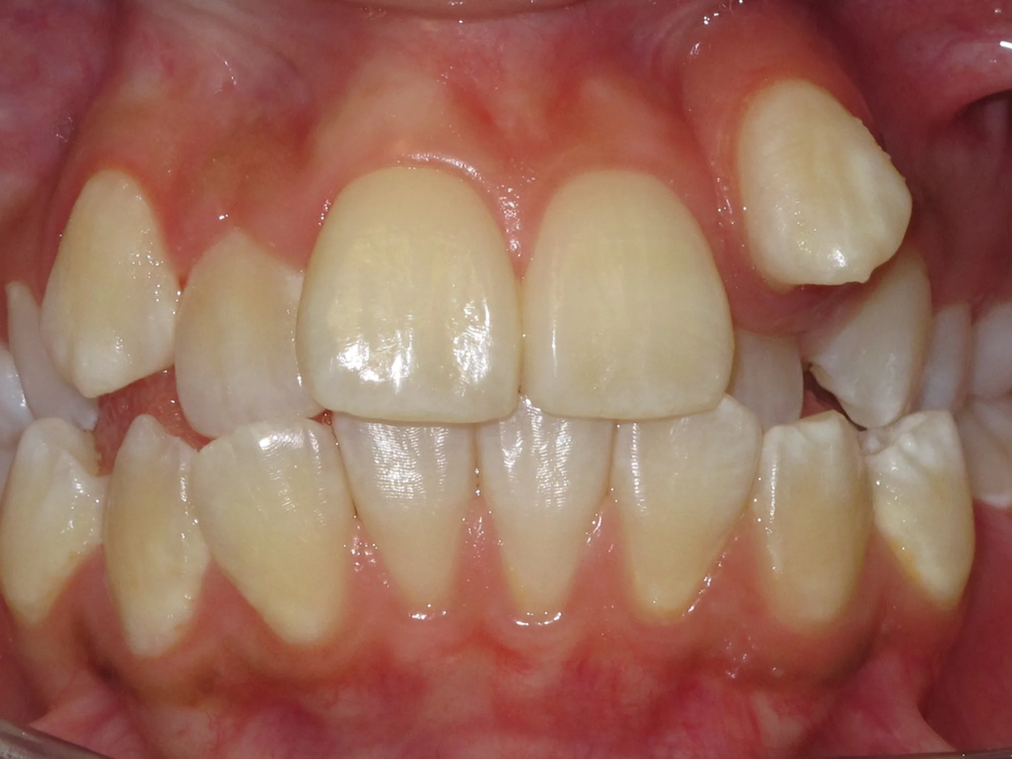 Crowded teeth with severe misalignment and overlapping