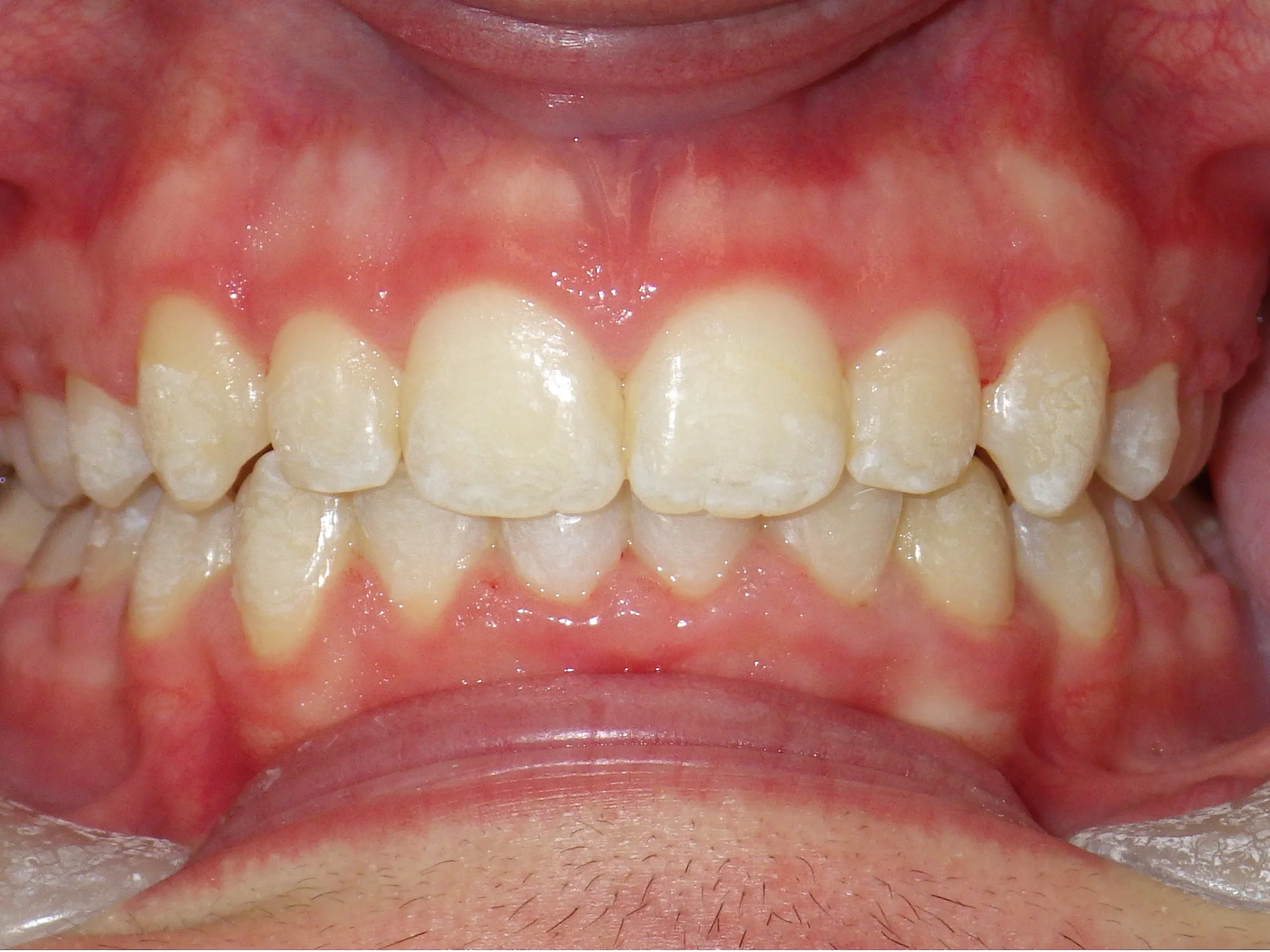 Close-up of straight and properly aligned teeth after completing orthodontic braces treatment