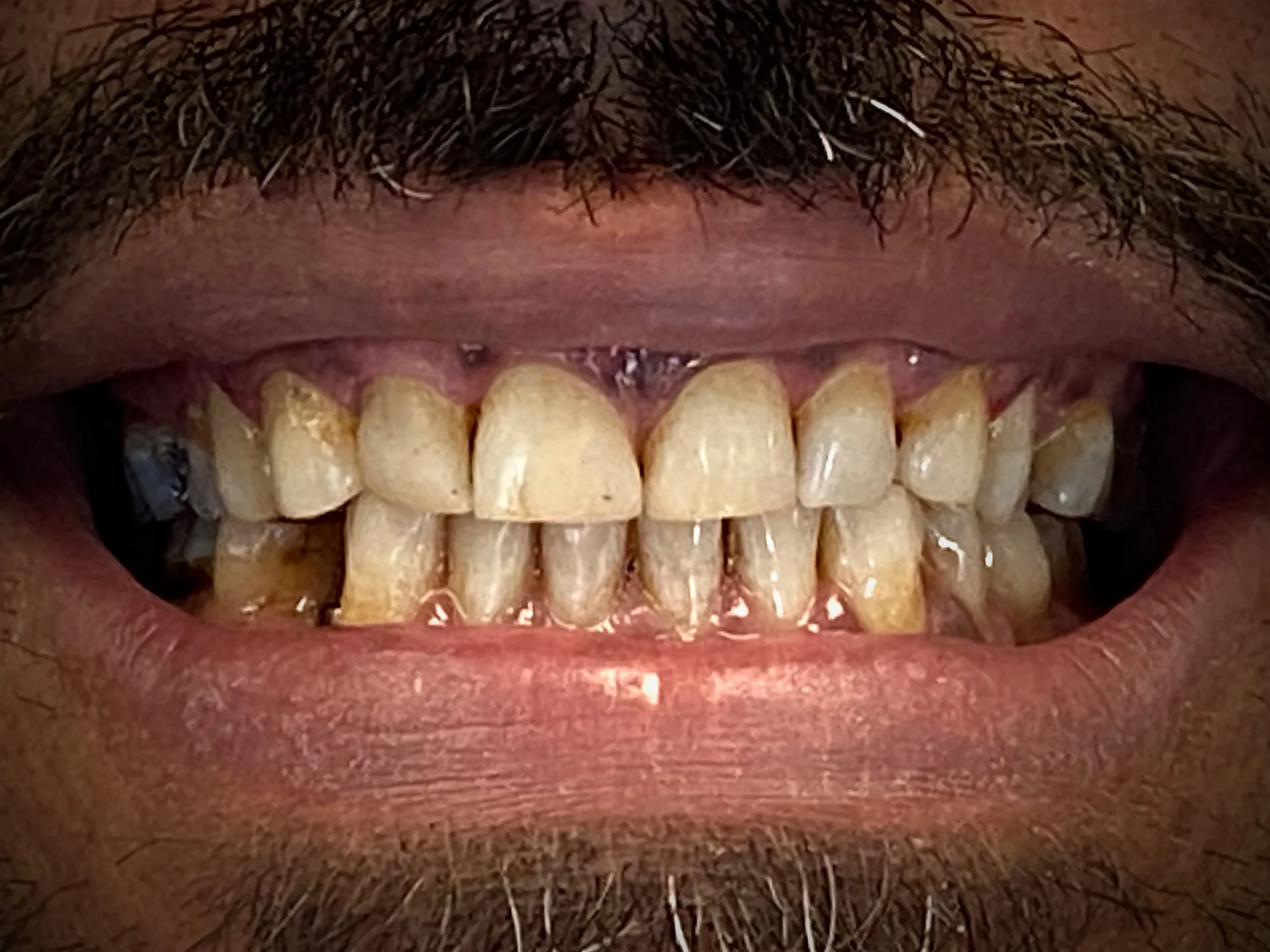 Discolored and uneven teeth with tartar buildup before porcelain veneers.