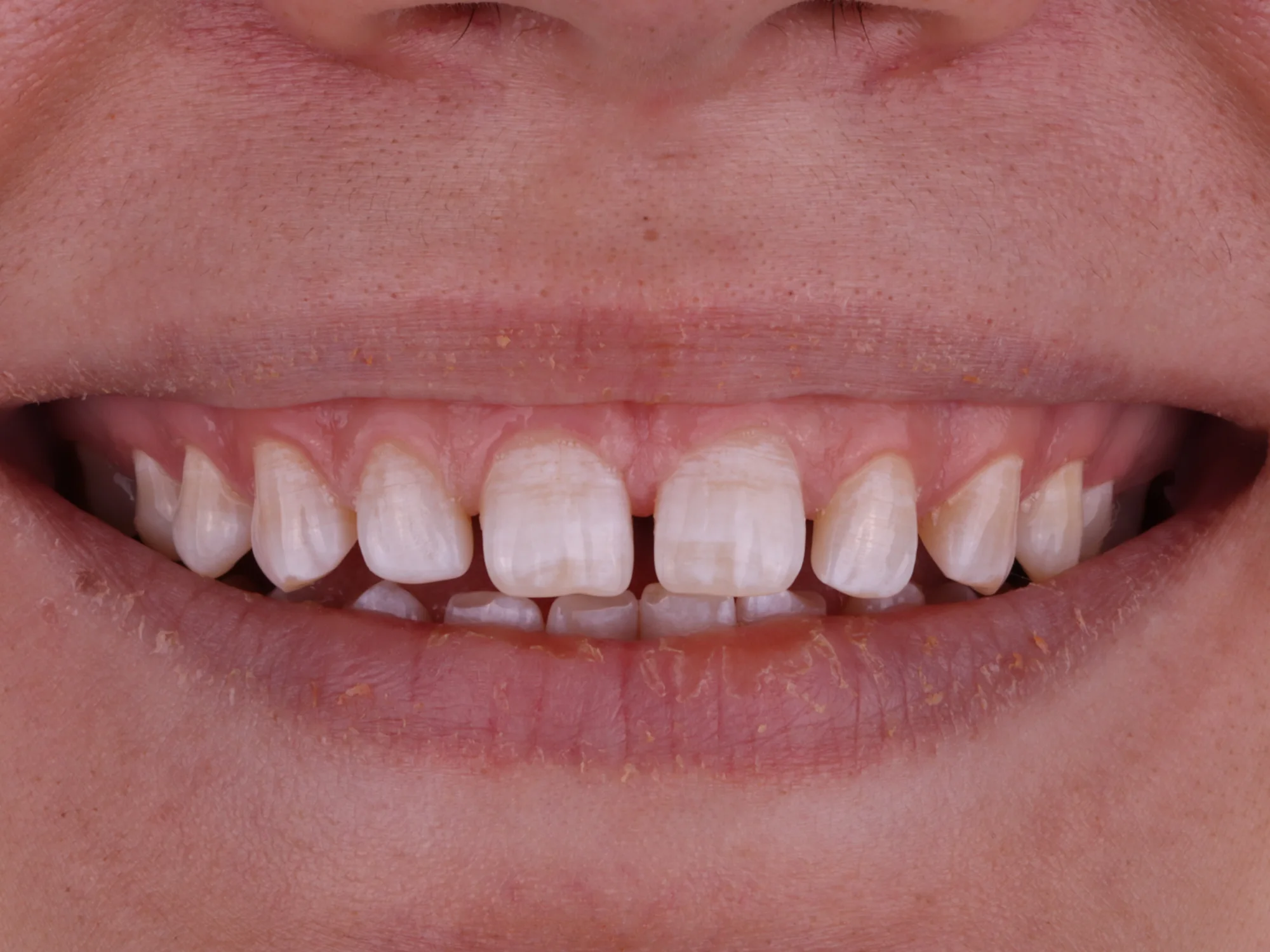 Close-up of uneven and discolored teeth before smile makeover treatment