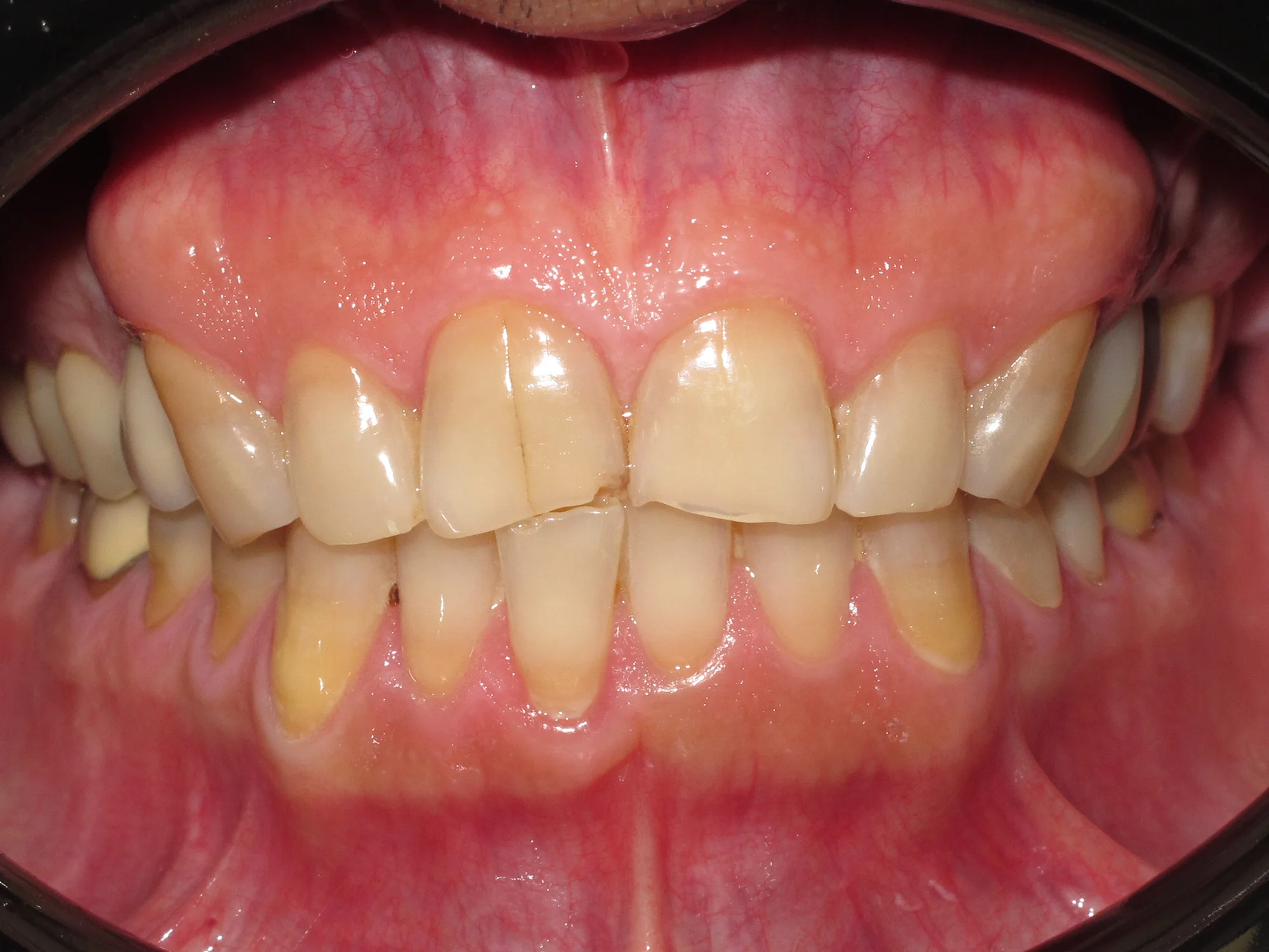 Close-up of a cracked and worn front tooth with visible enamel damage and discoloration