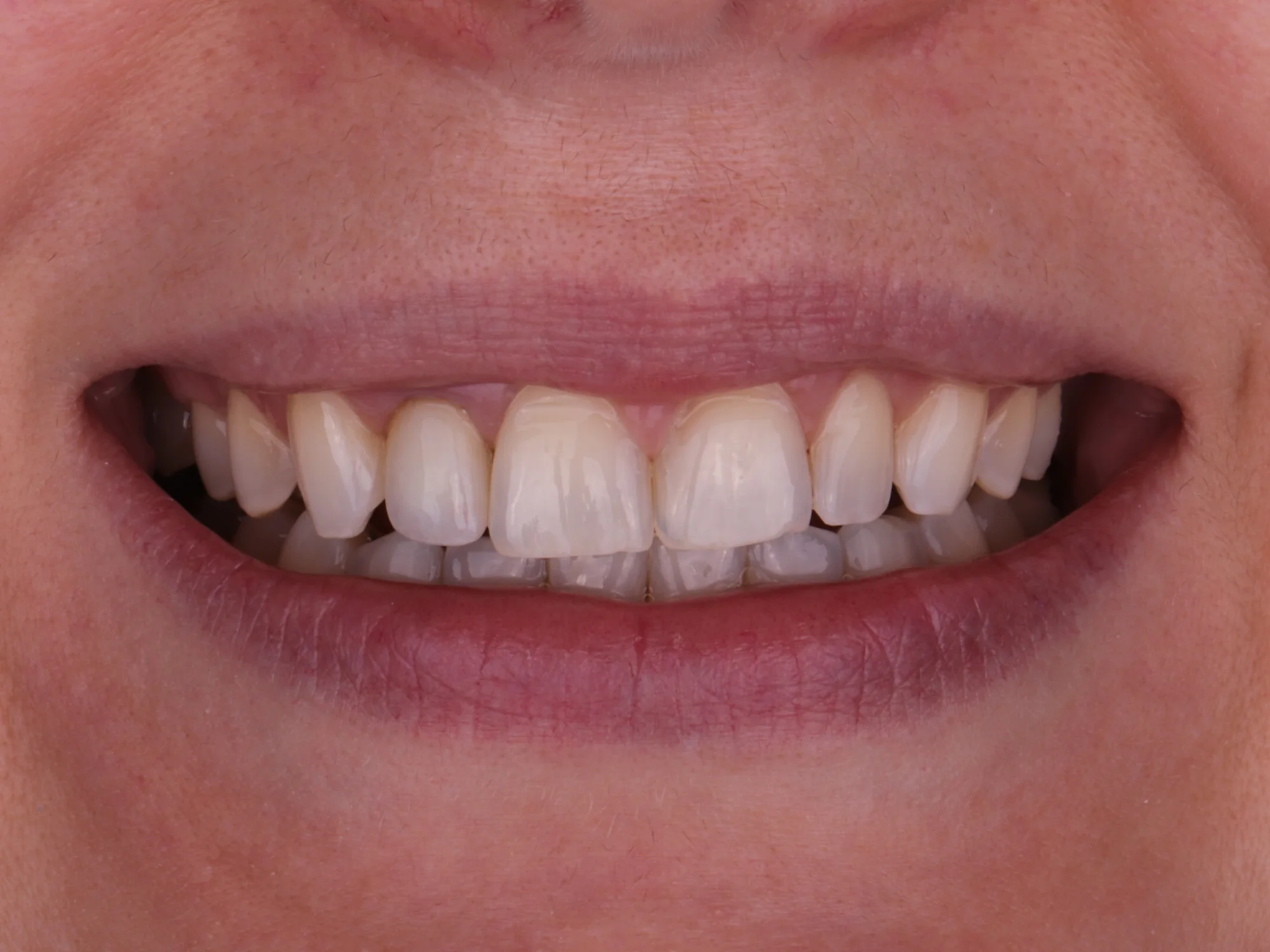 Uneven teeth with noticeable differences in shape and color, appearing less attractive.