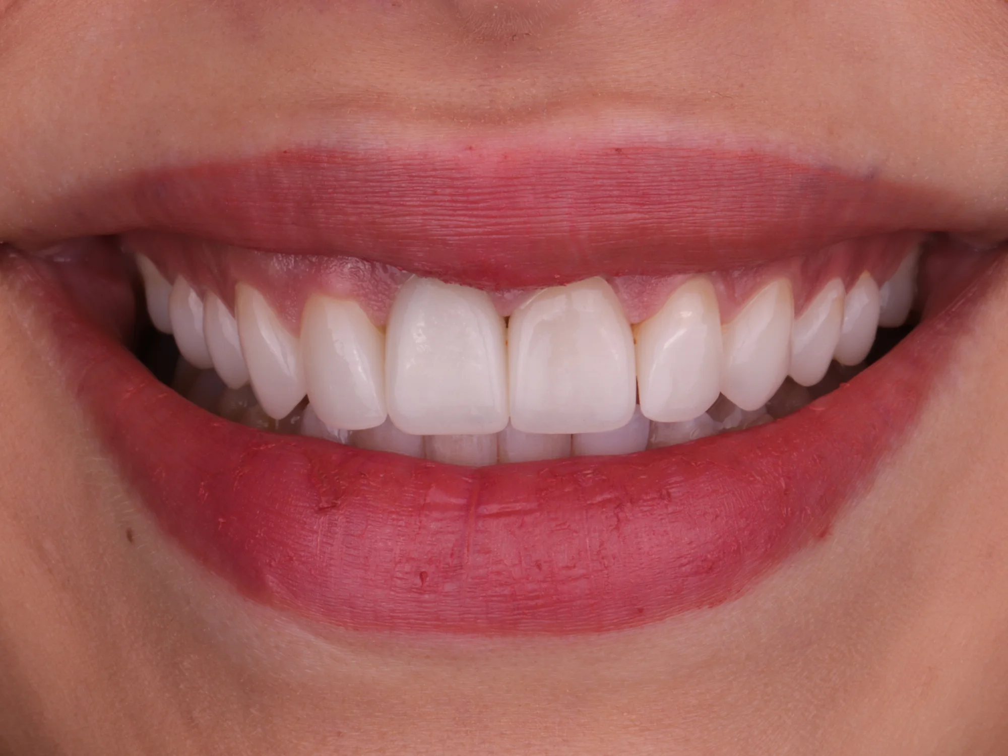Close-up of front teeth after porcelain veneer treatment at Mississauga Smiles Dentistry