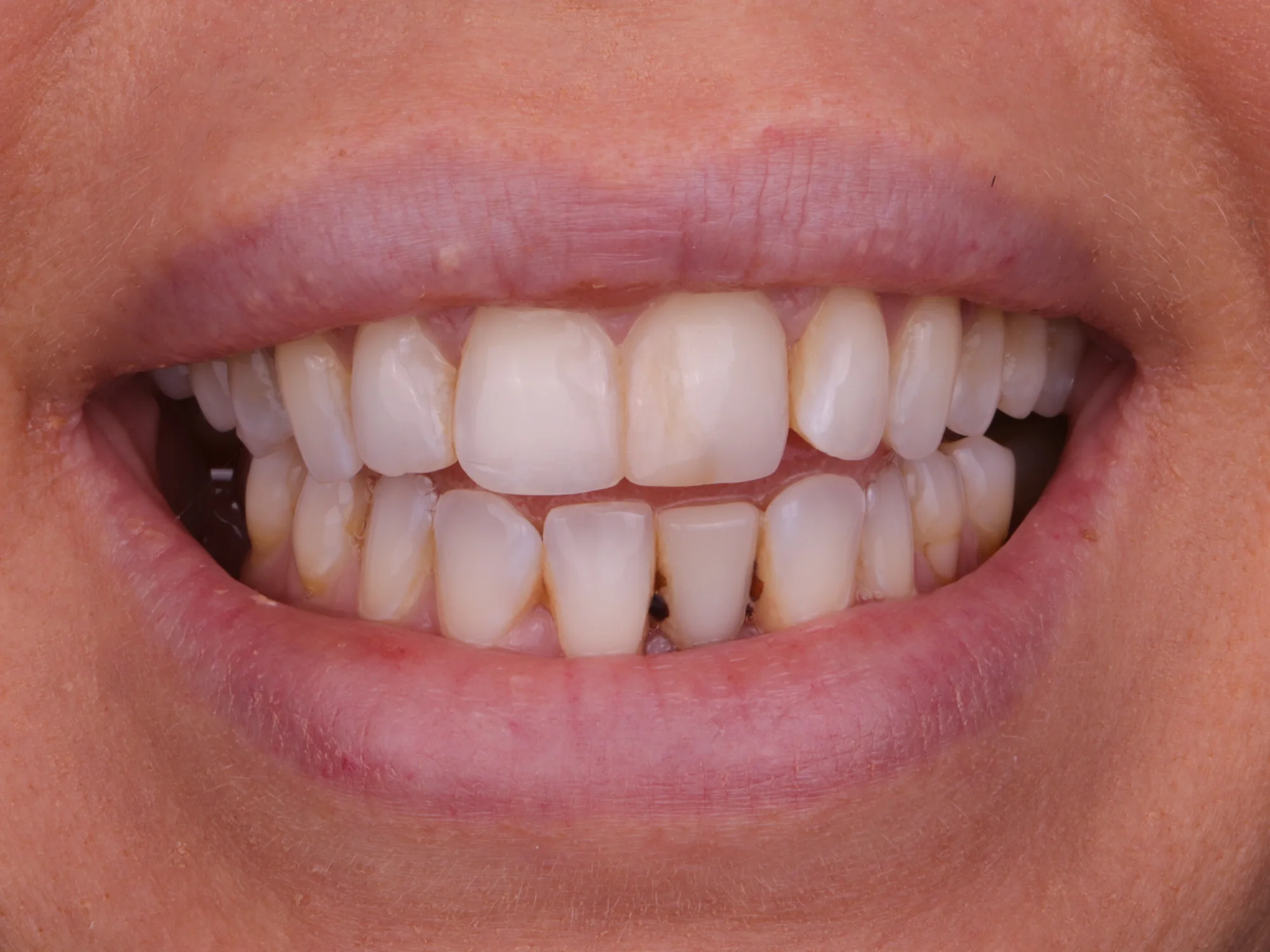 Close-up of stained, uneven teeth before getting veneers at Mississauga Smiles Dentistry.