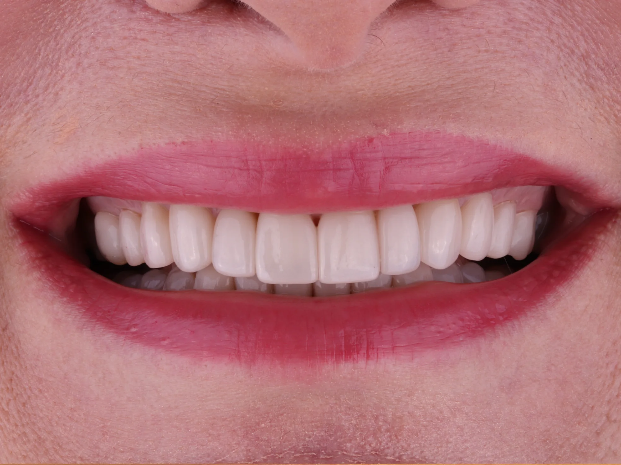 Close-up of a perfect smile after porcelain veneers at Mississauga Smiles Dentistry.