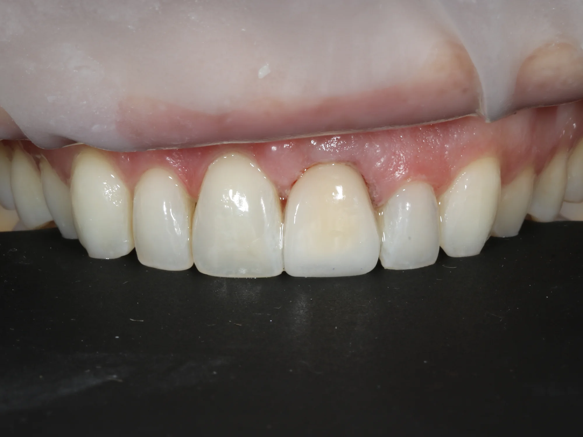 Front tooth restored with natural look after Same day Crown-Veneer at Mississauga Smiles Dentistry.