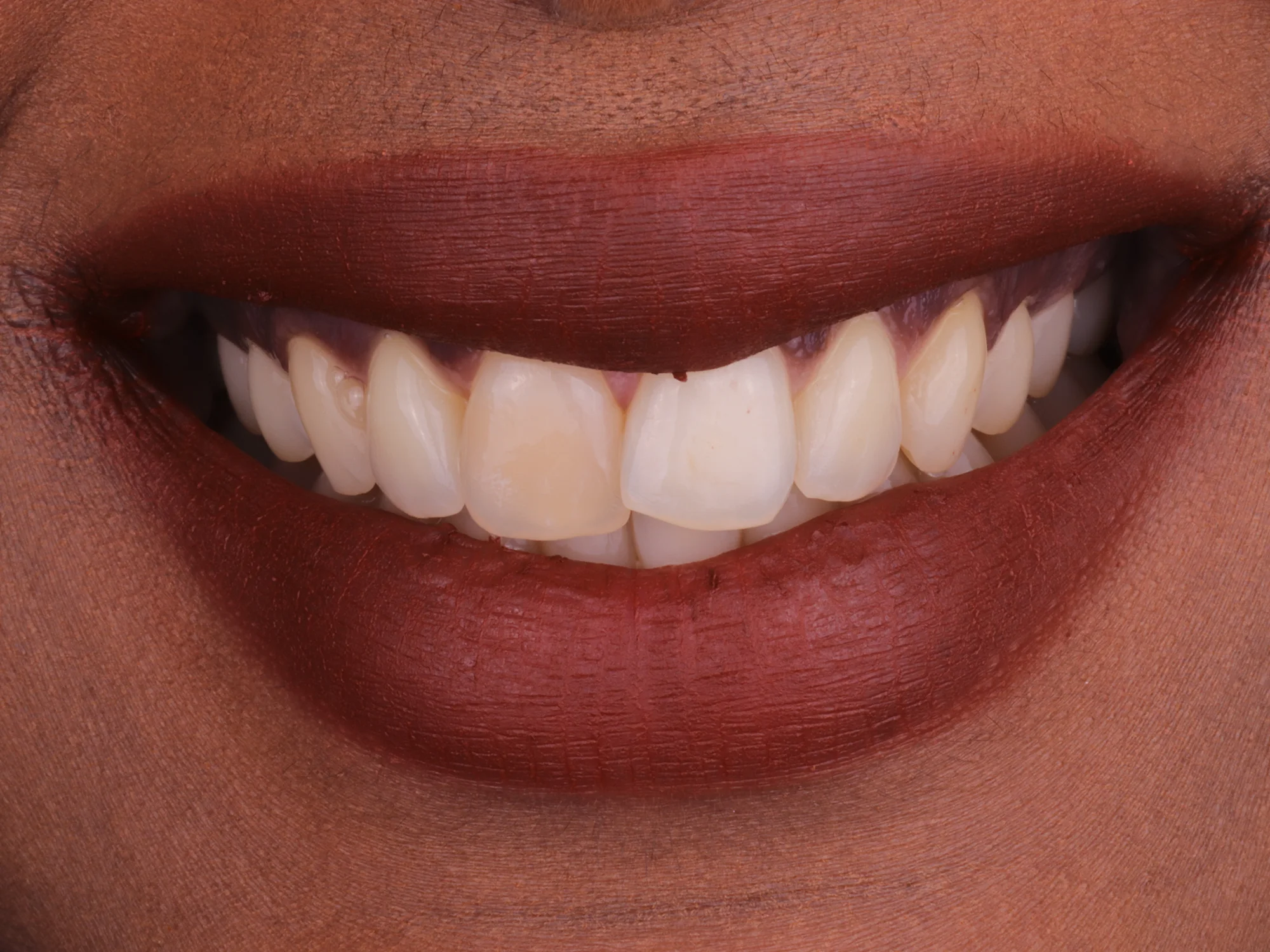 Close-up of natural smile before cosmetic dental treatment such as veneers or same-day crowns.