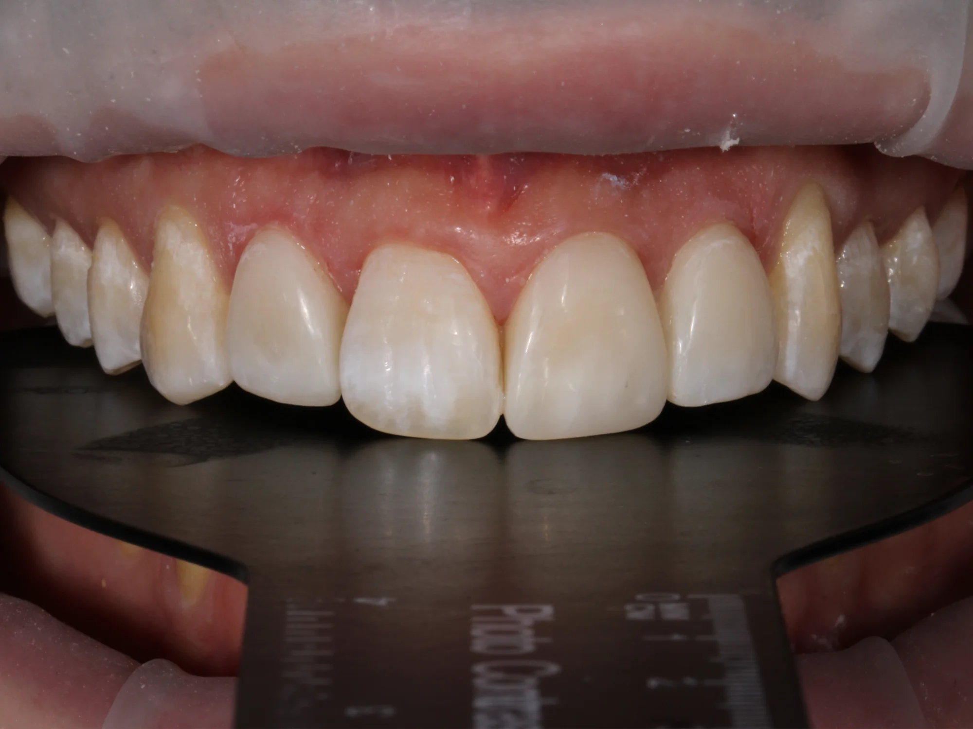 Aligned and bright upper teeth after smile makeover