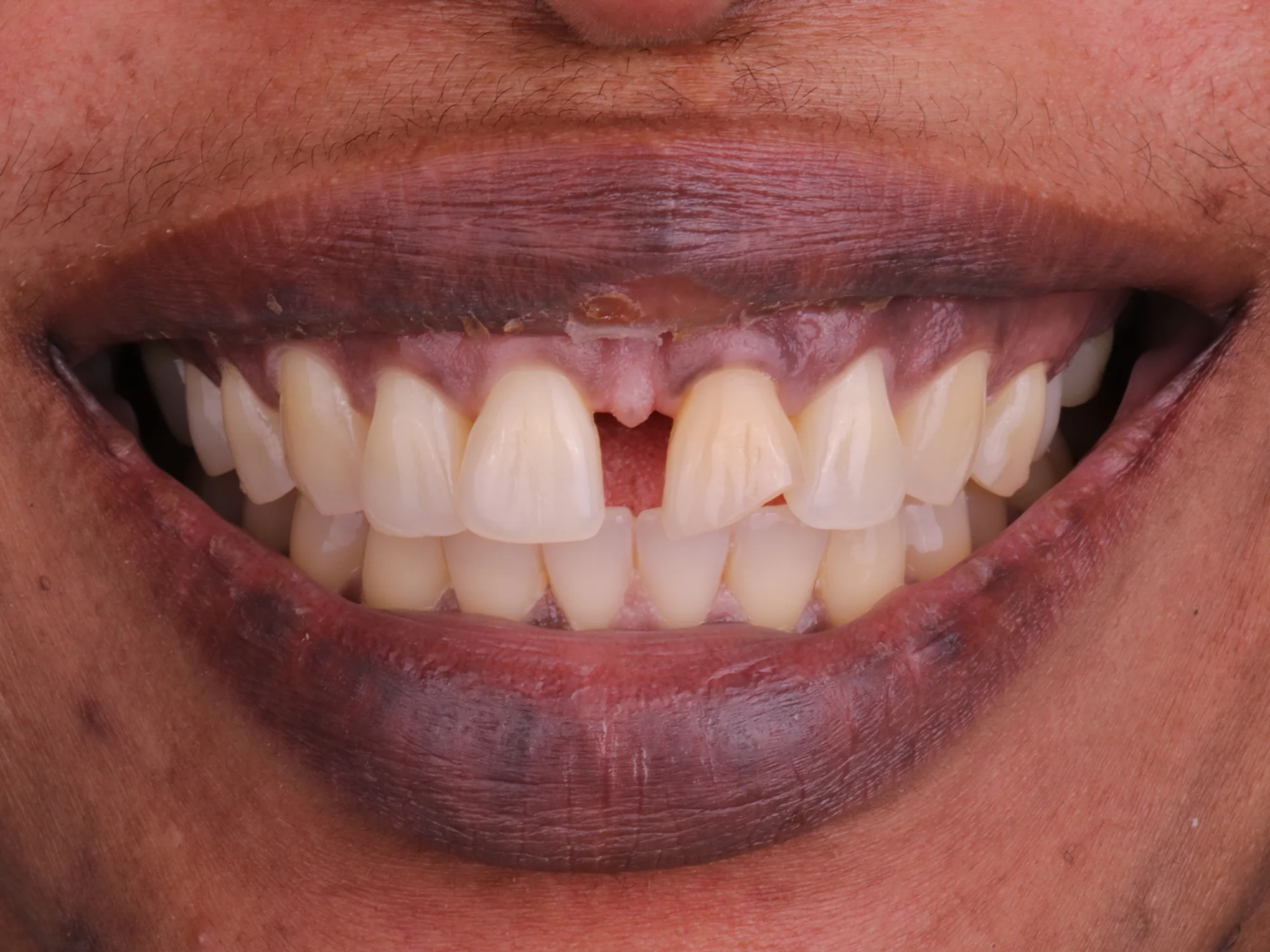 Visible gap between upper front teeth showing gum exposure before porcelain veneers.